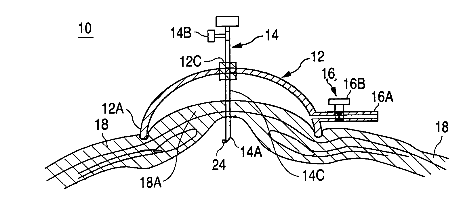 Vacuum-actuated tissue perforation device for establishing pneumoperitoneum