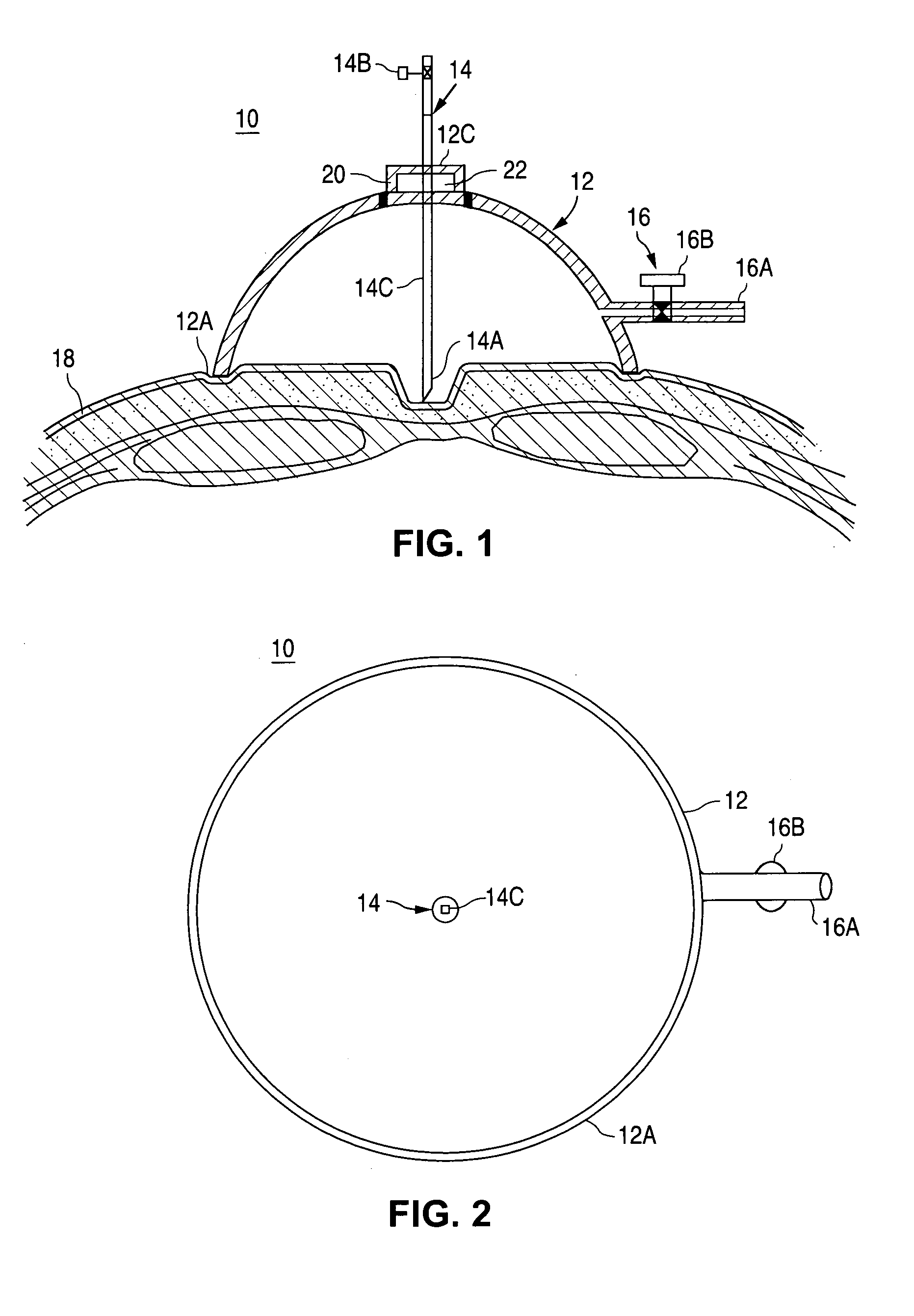 Vacuum-actuated tissue perforation device for establishing pneumoperitoneum