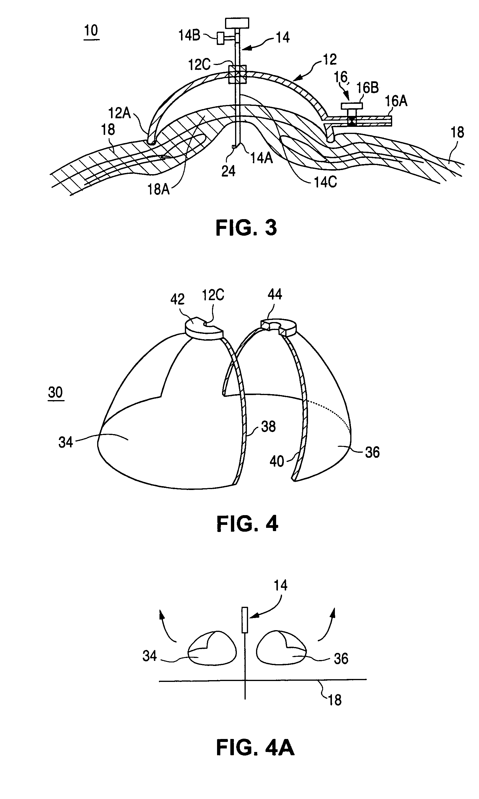 Vacuum-actuated tissue perforation device for establishing pneumoperitoneum