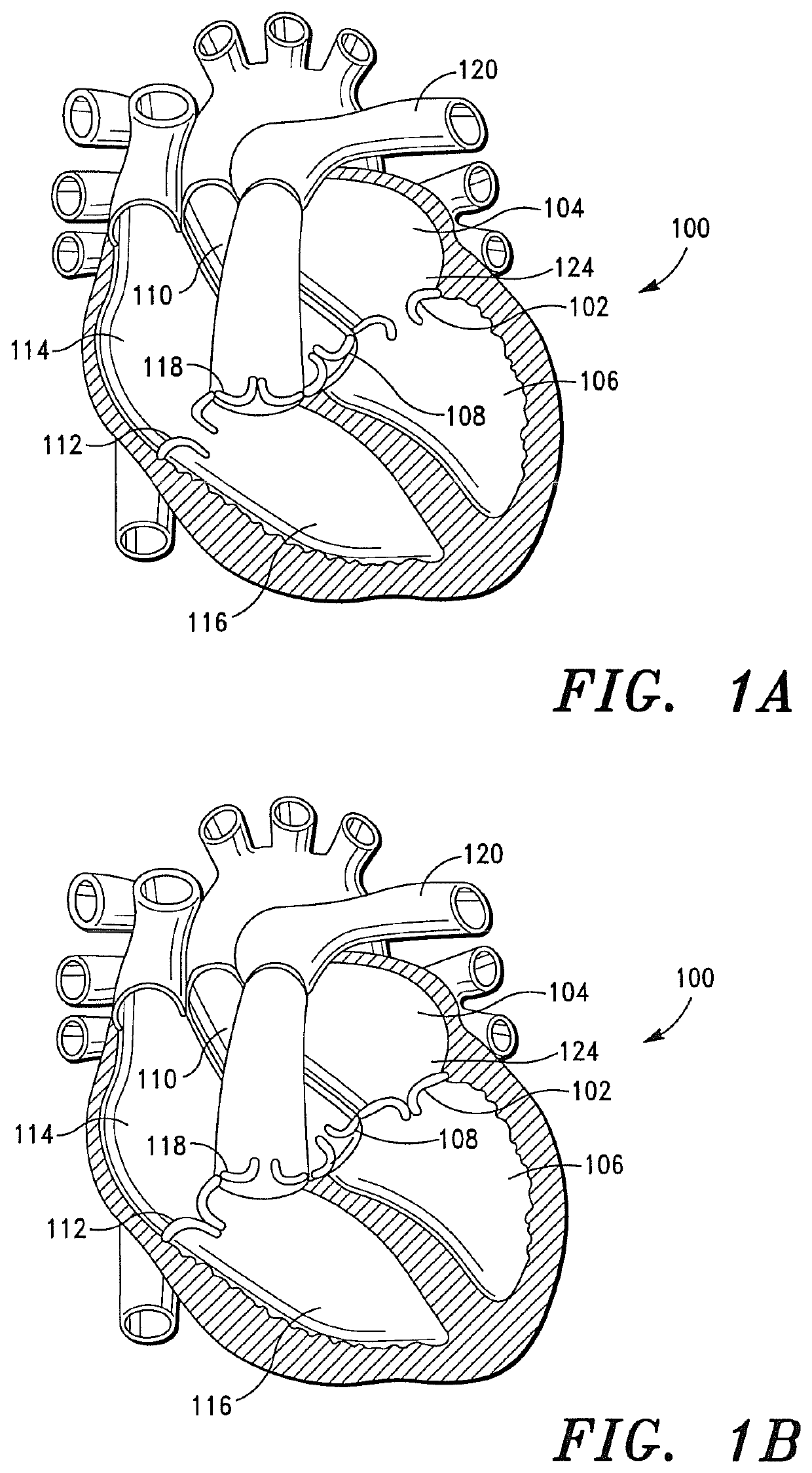 Prosthetic cardiovascular valves and methods for replacing native atrioventricular valves with same