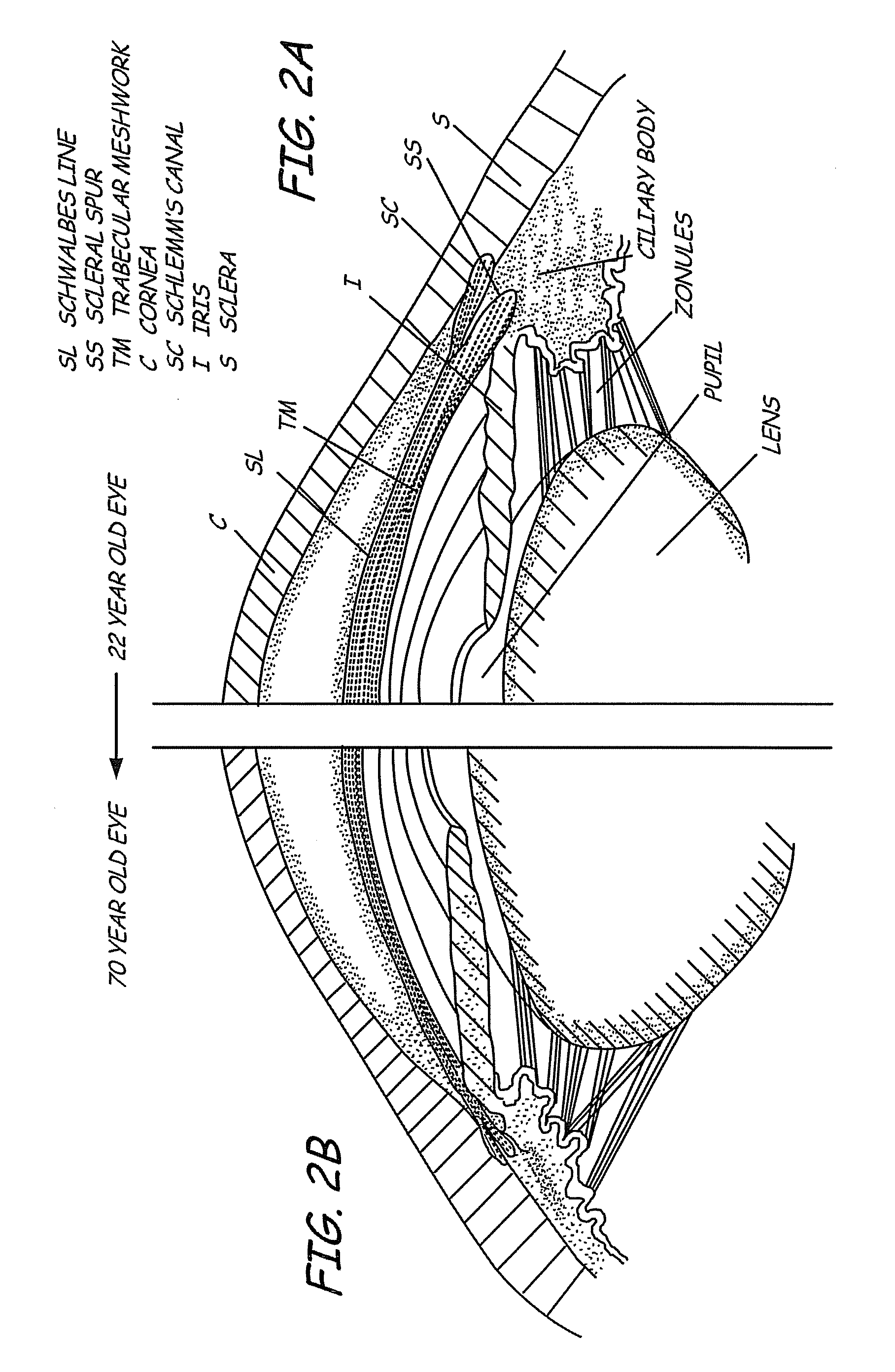 Method and apparatus for prevention and treatment of adult glaucoma