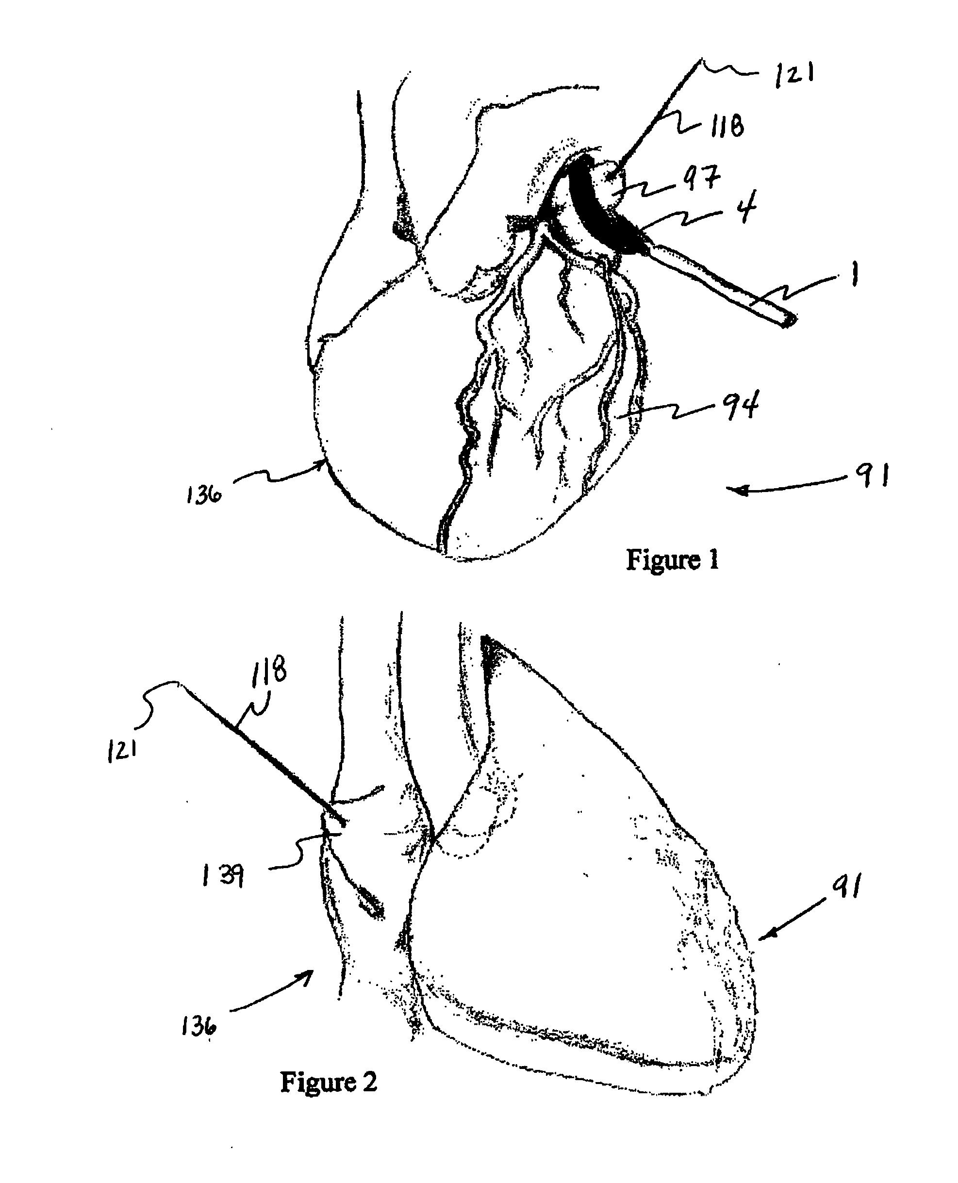 System for tissue cavity closure