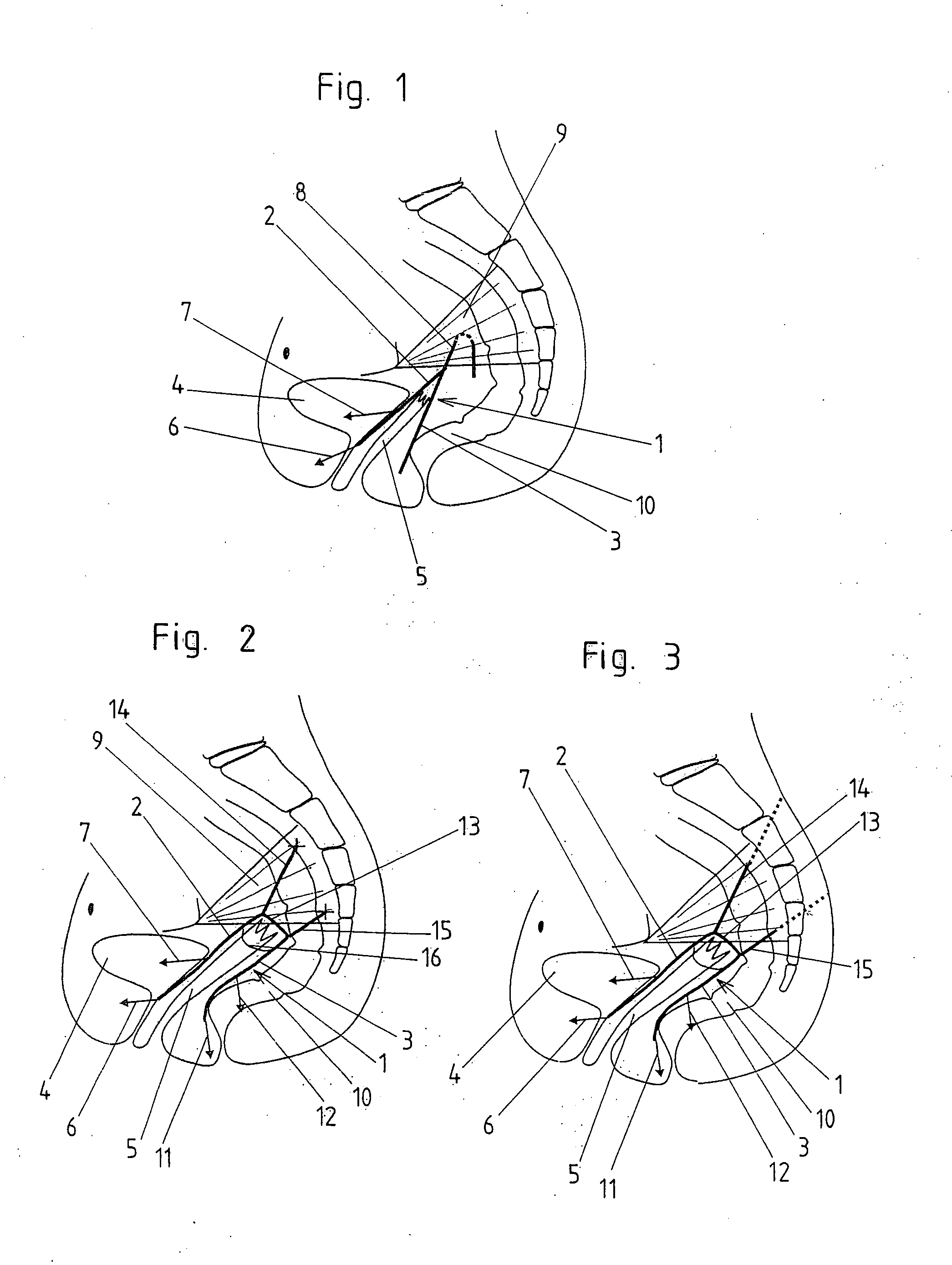 Implantable mesh for surgical reconstruction in the area of the pelvic floor