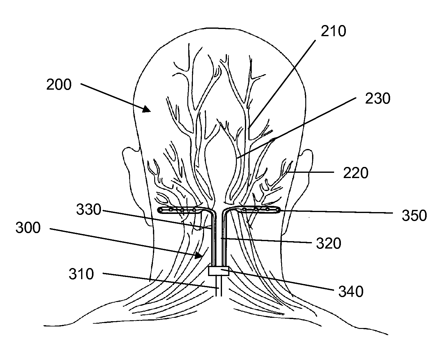 Bifurcated lead system and apparatus