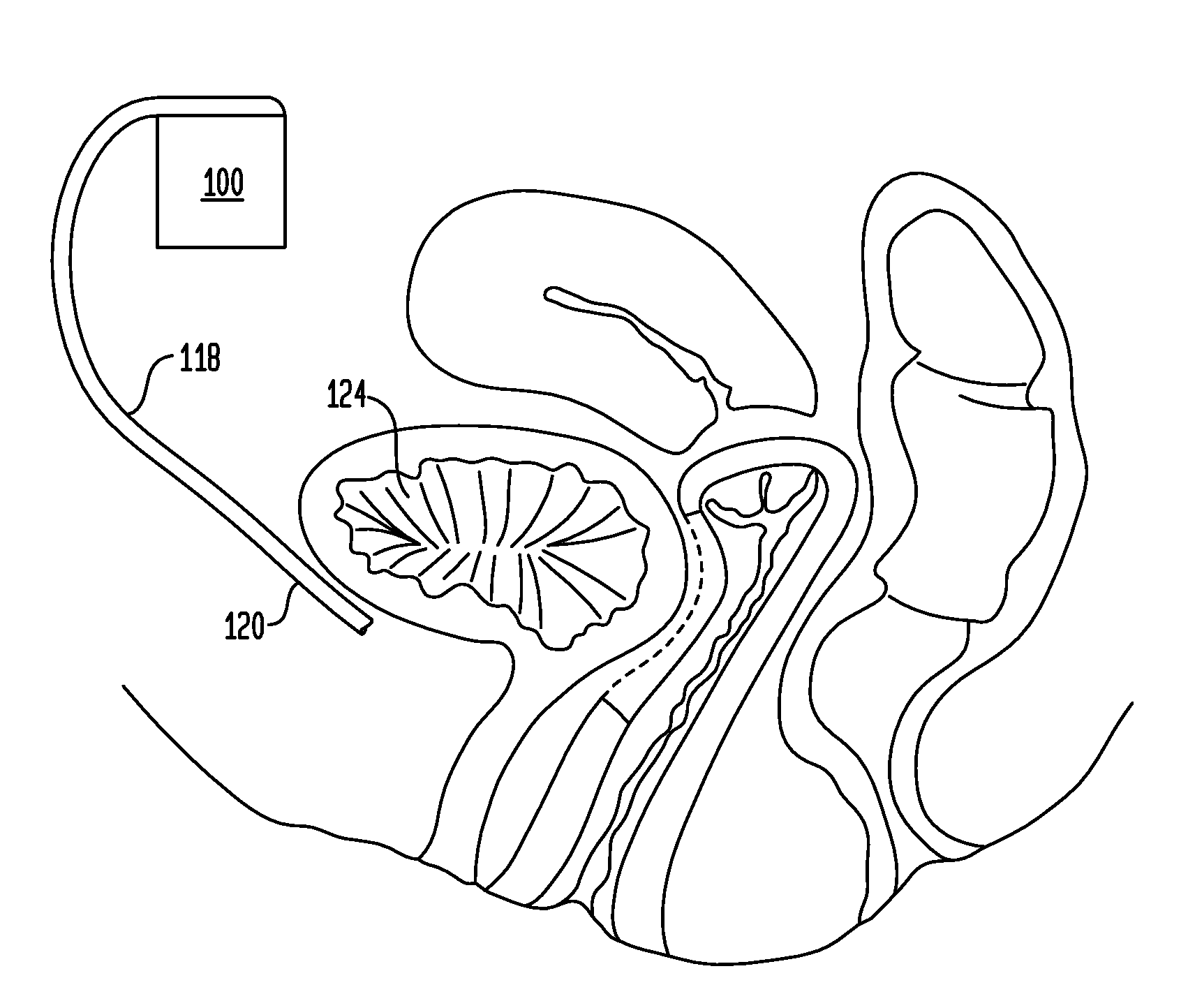 Implantable pulse generators and methods for selective nerve stimulation