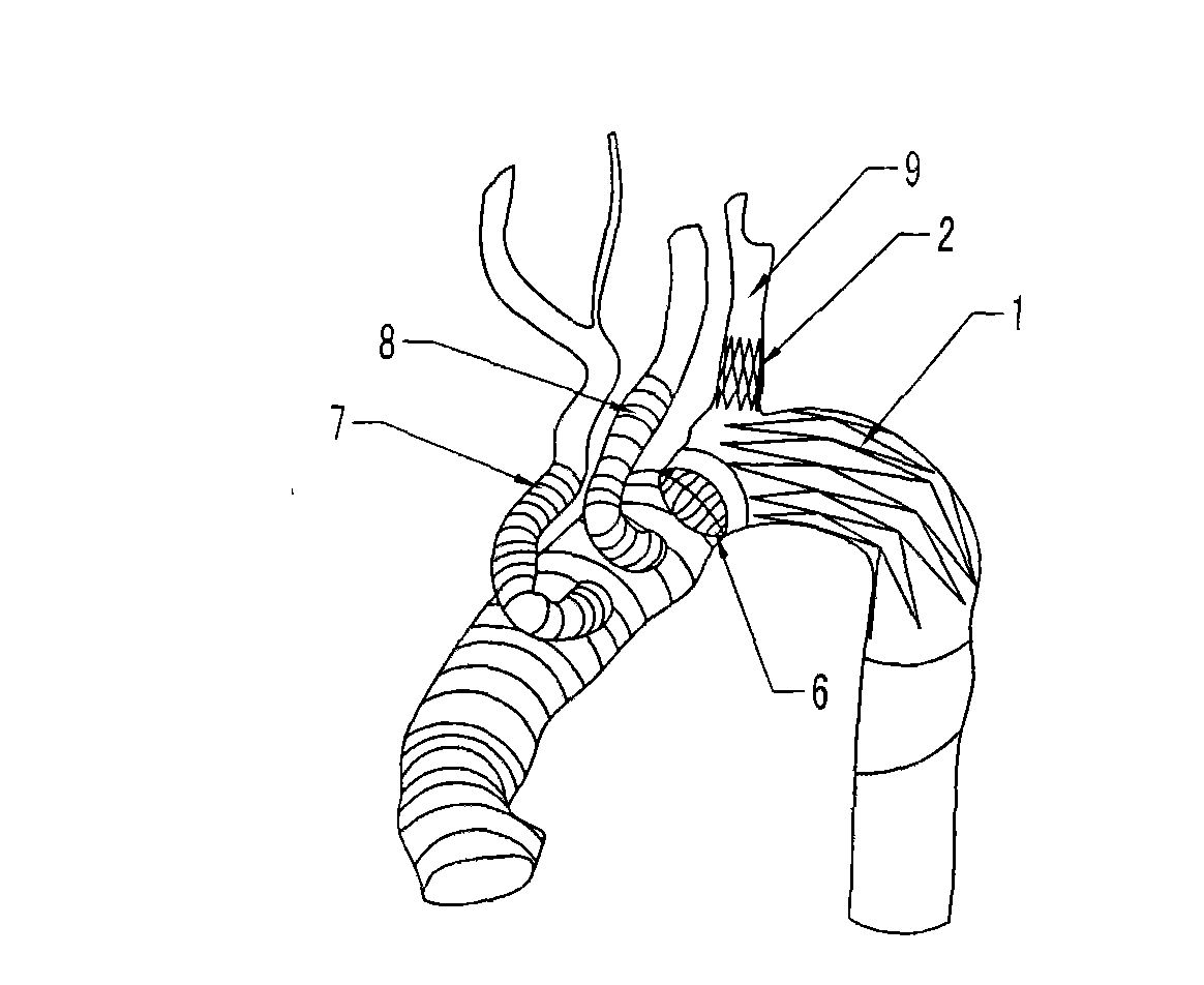 Branch artificial blood vessel bracket applied in surgery