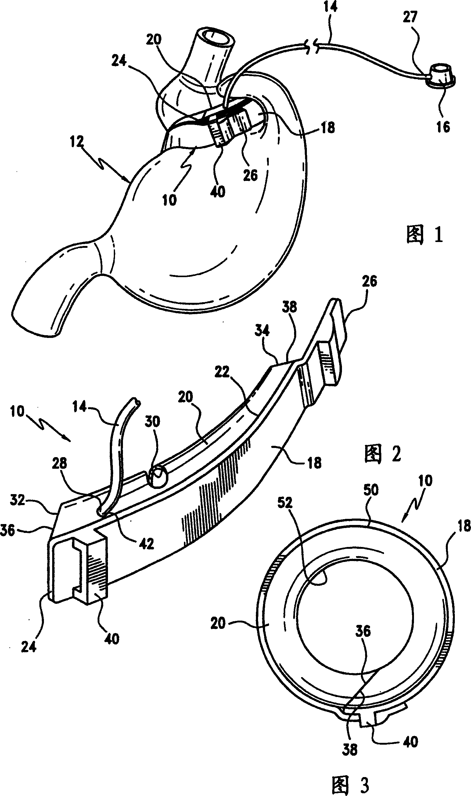 Gastric band with mating end profiles