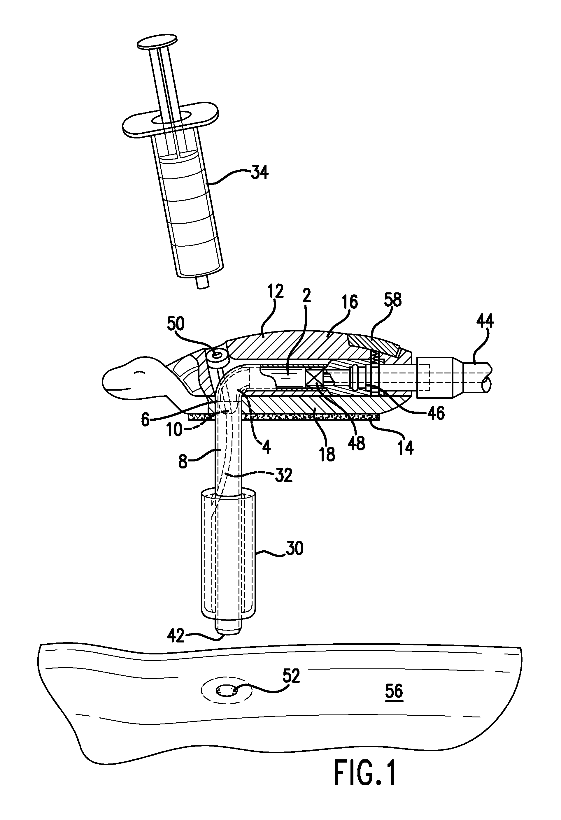 Enteral feeding tube and housing