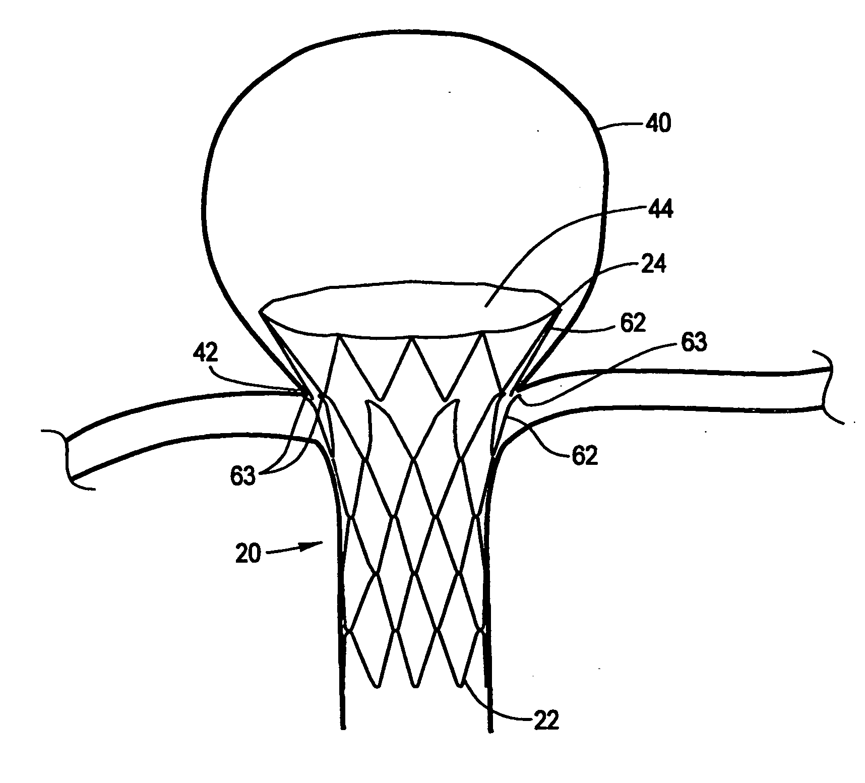 Bifurcation aneurysm treatment stent with distal web