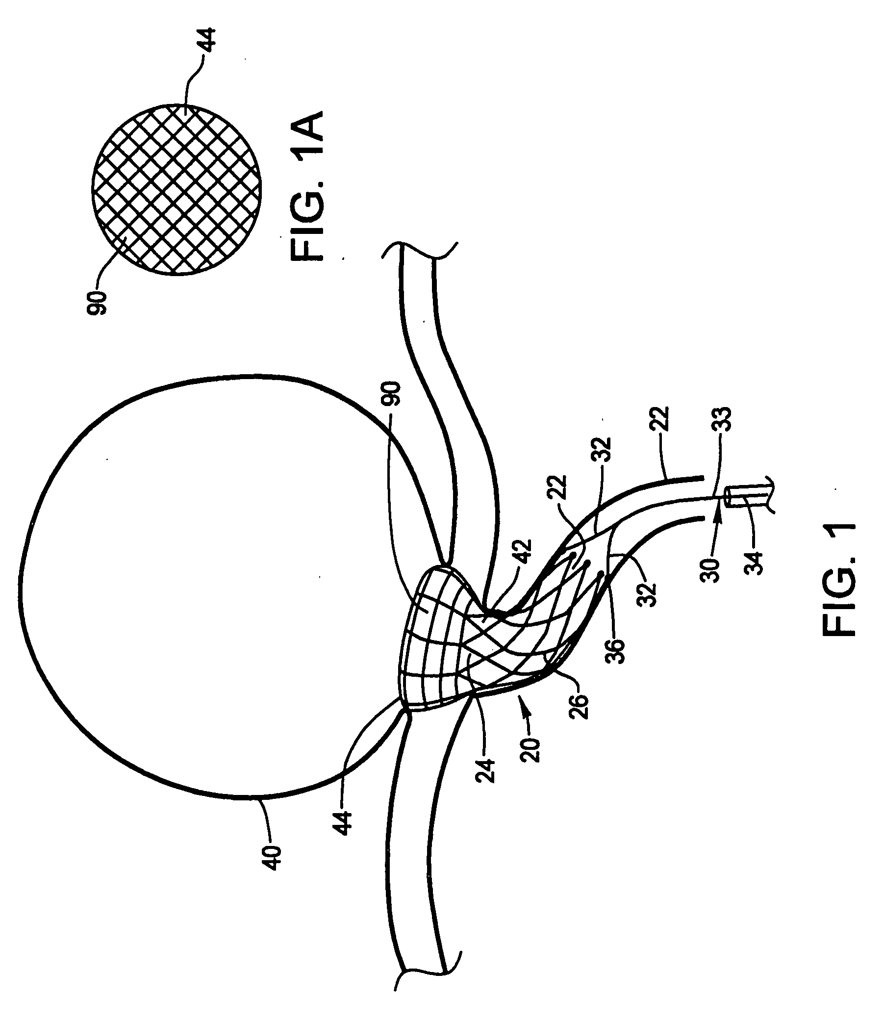 Bifurcation aneurysm treatment stent with distal web