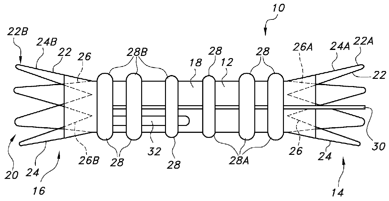 Advanced kink resistant stent graft