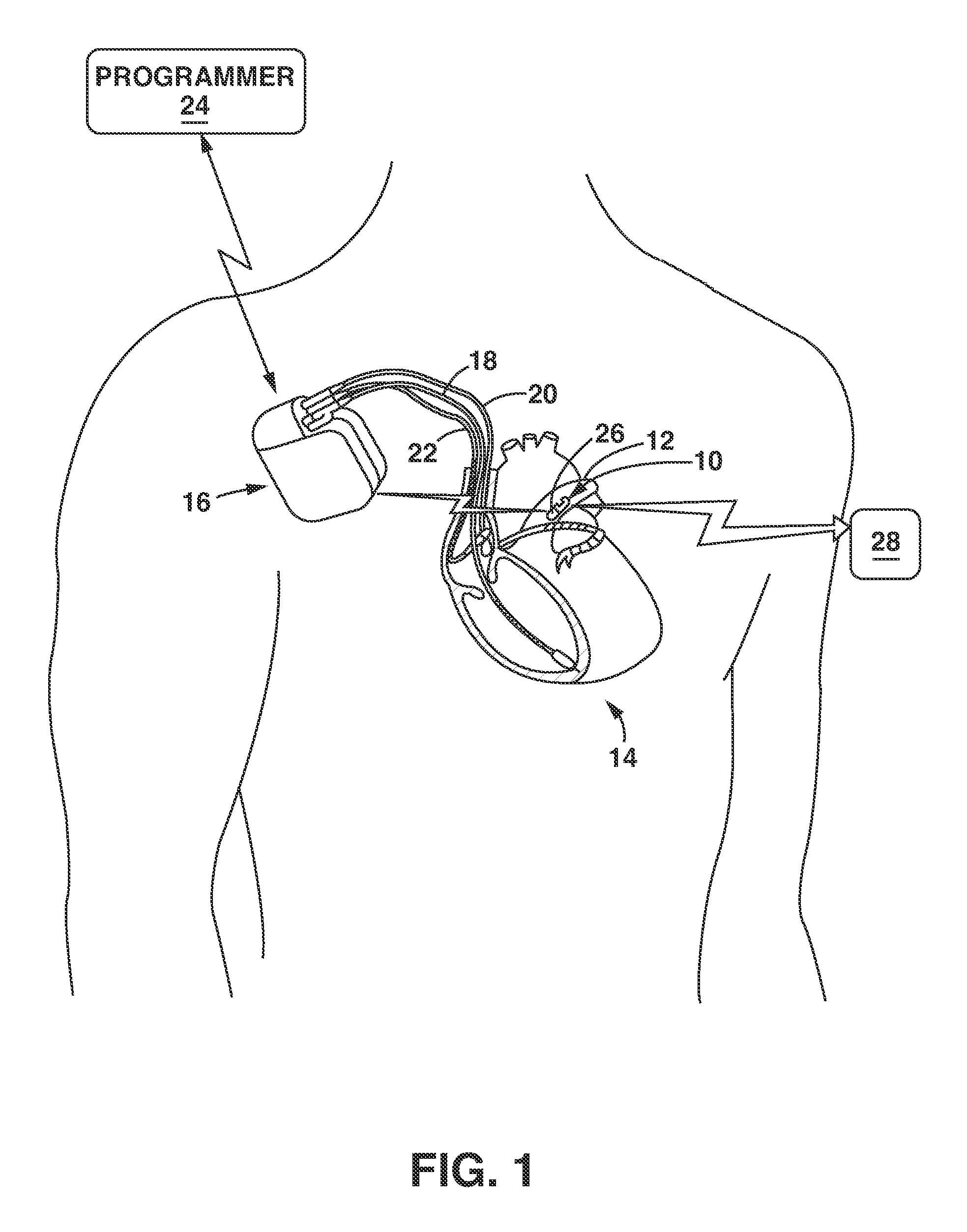 Implantable medical sensor and fixation system