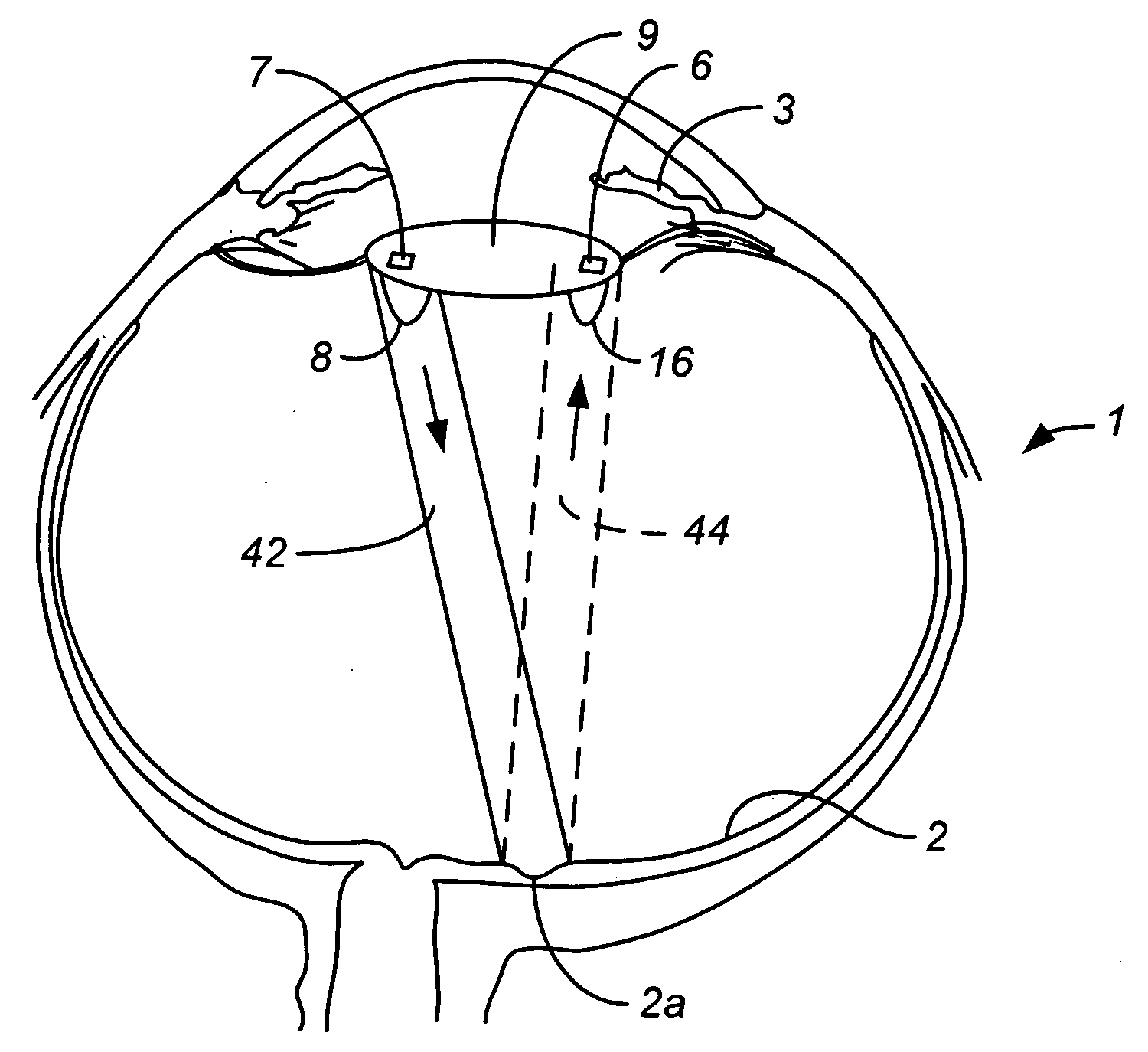 Intraocular lens measurement of blood glucose