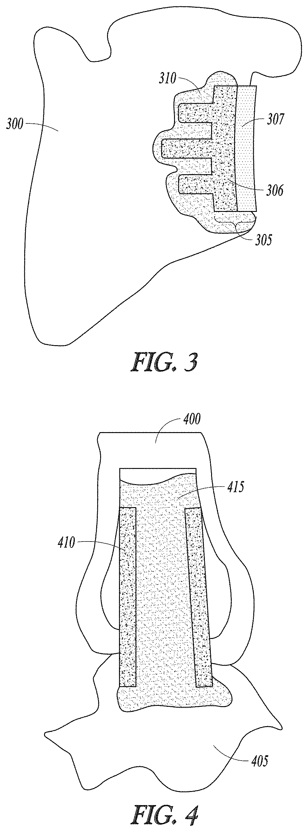 Curable calcium phosphate compositions for use with porous structures and methods of using the same