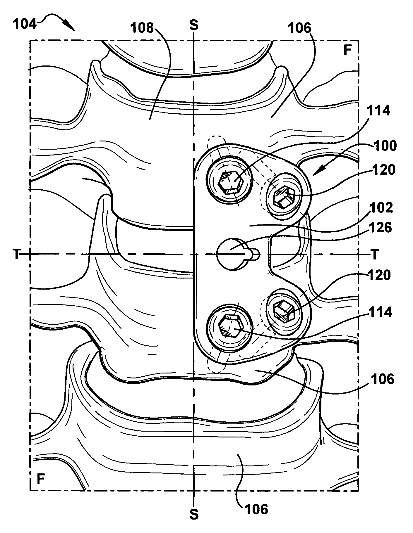 Cervical fusion apparatus and method for use