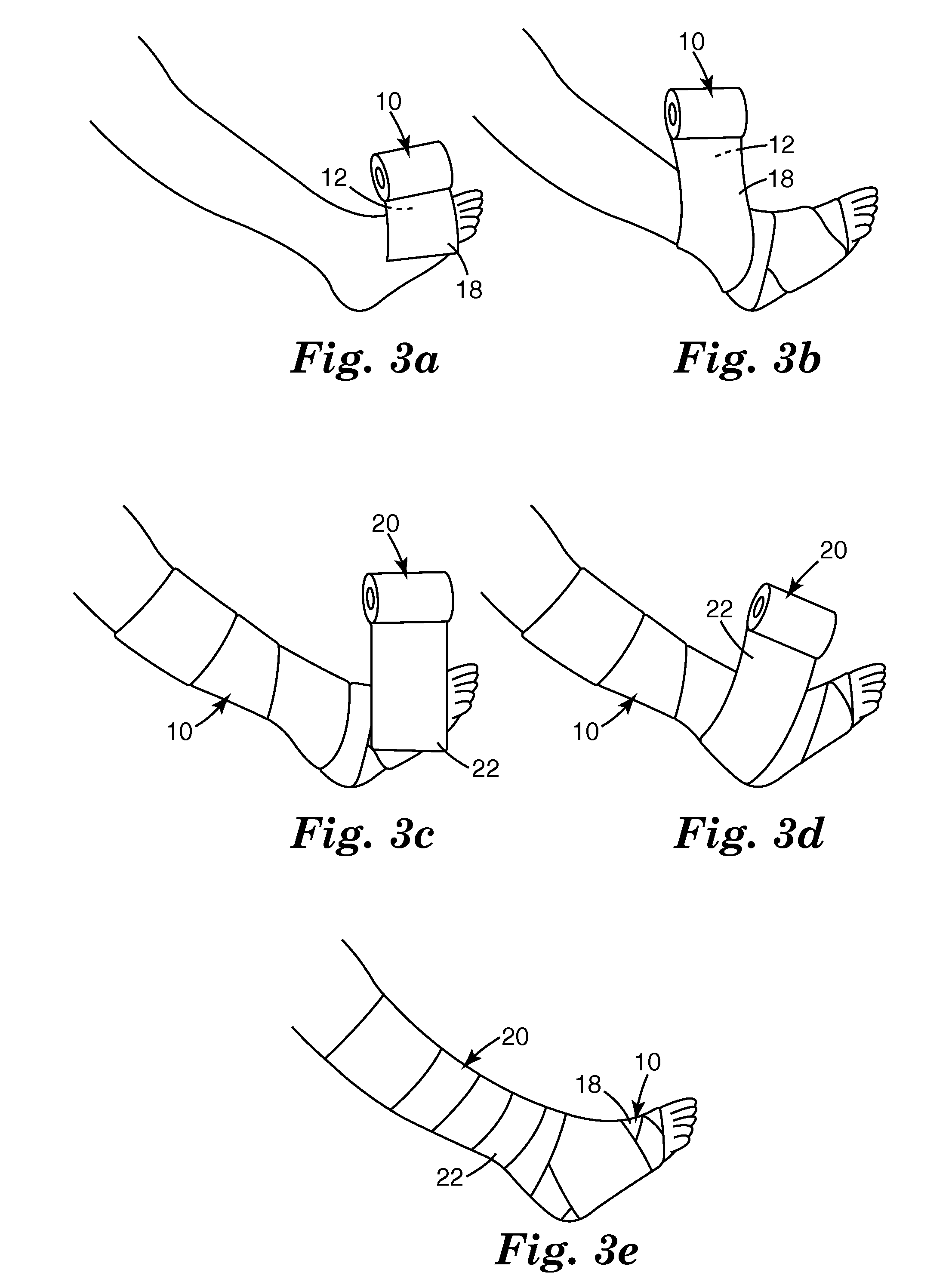 Compression bandage system