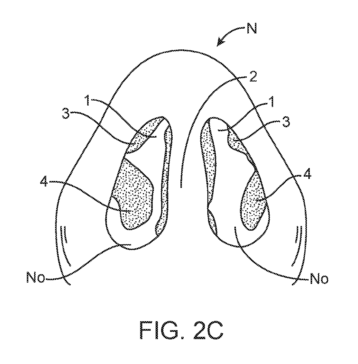 Methods and devices to treat nasal airways