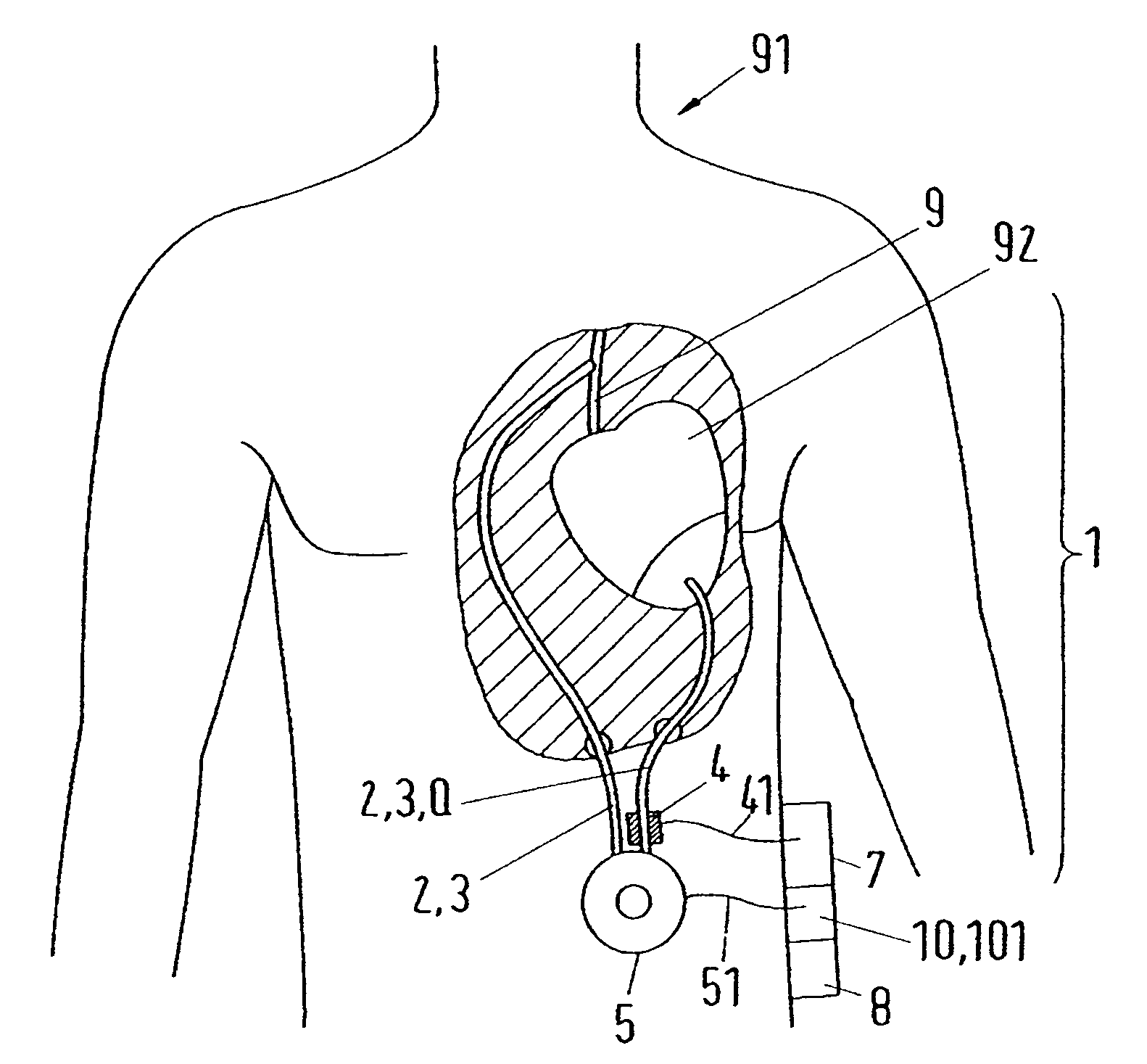 Method for the calibration of a flow measurement in a flow system, and flow system for carrying out the method