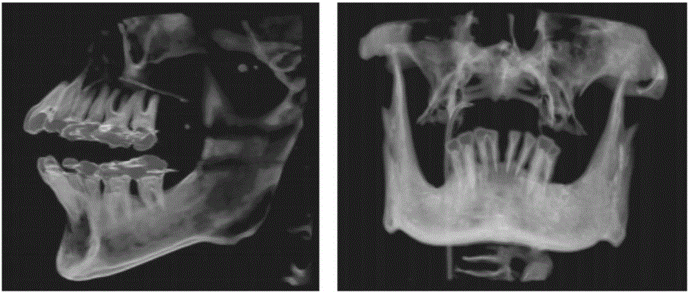 An oral cavity soft and hard tissue CT sequence and three-dimensional grid model registration method