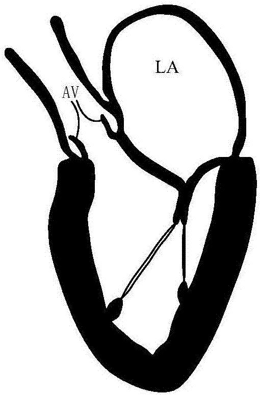 Artificial chordae tendineae and artificial chordae tendineae implanting system