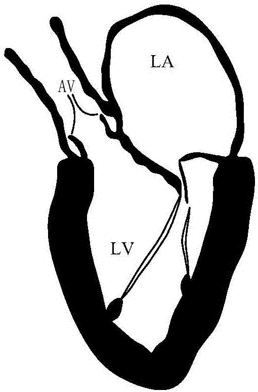 Artificial chordae tendineae and artificial chordae tendineae implanting system