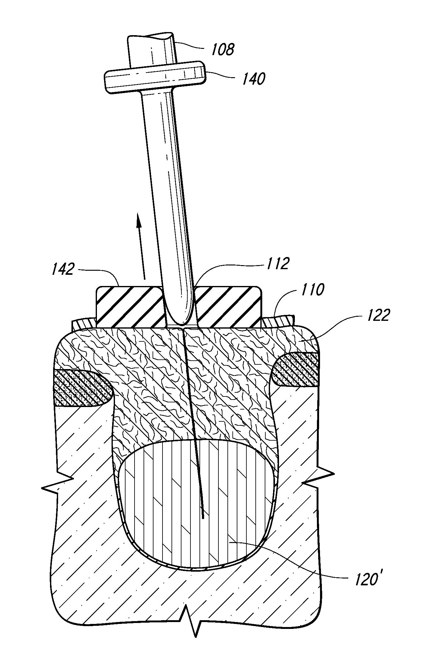 Therapeutic Tooth Bud Ablation