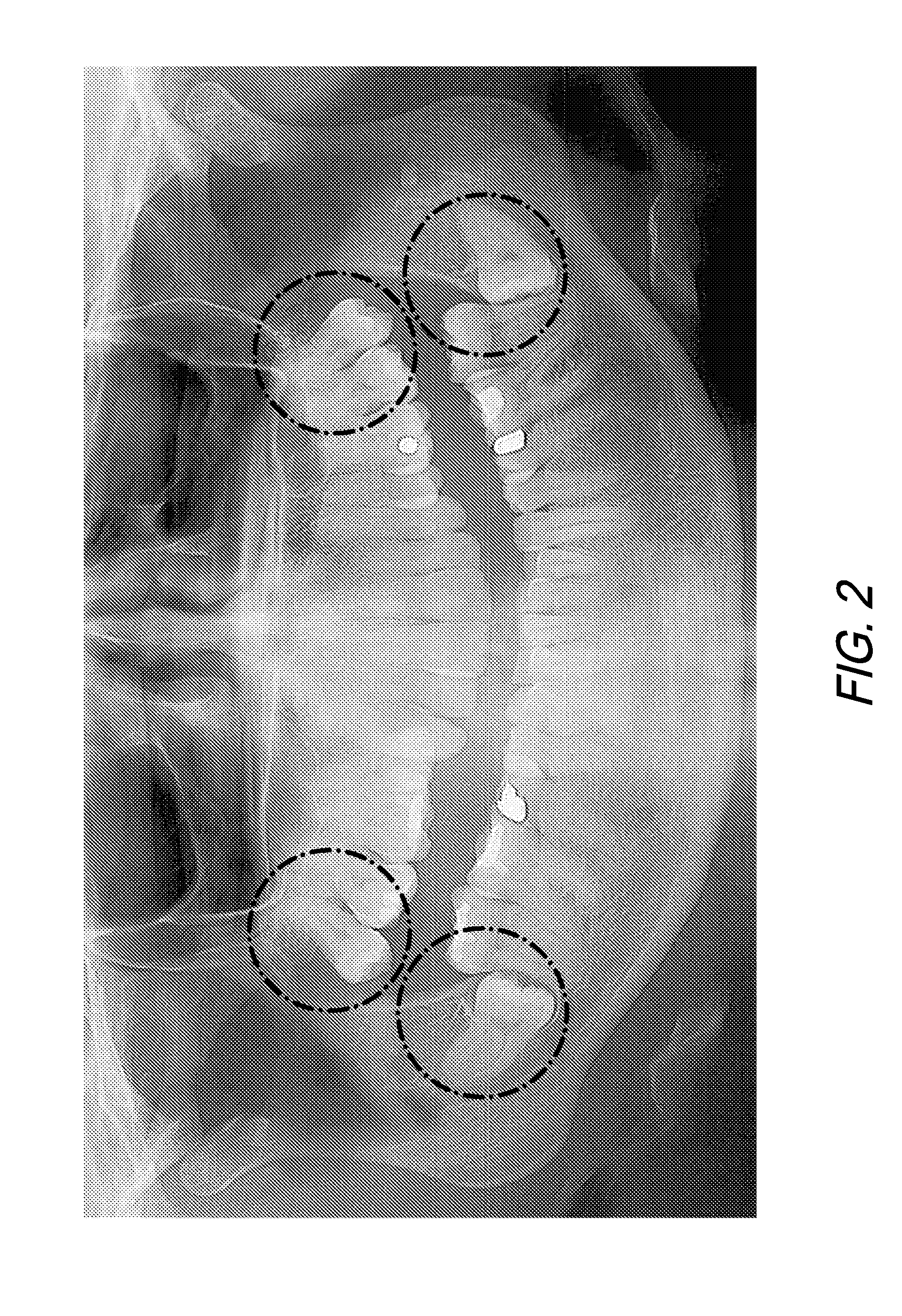 Therapeutic Tooth Bud Ablation