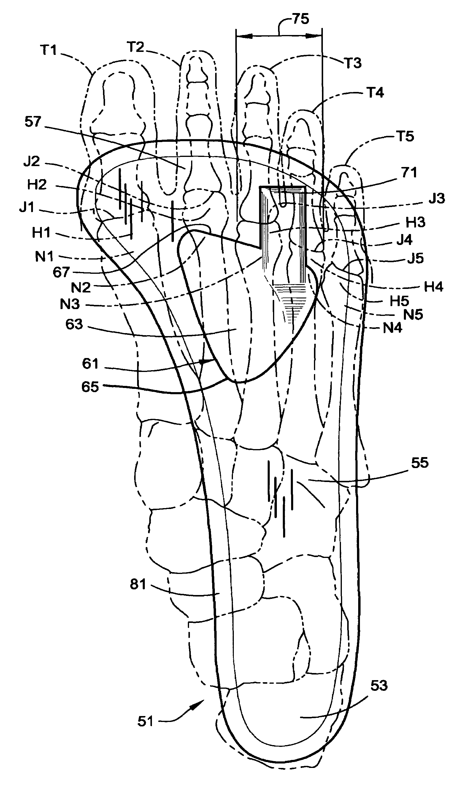 Insole with a neuroma pad