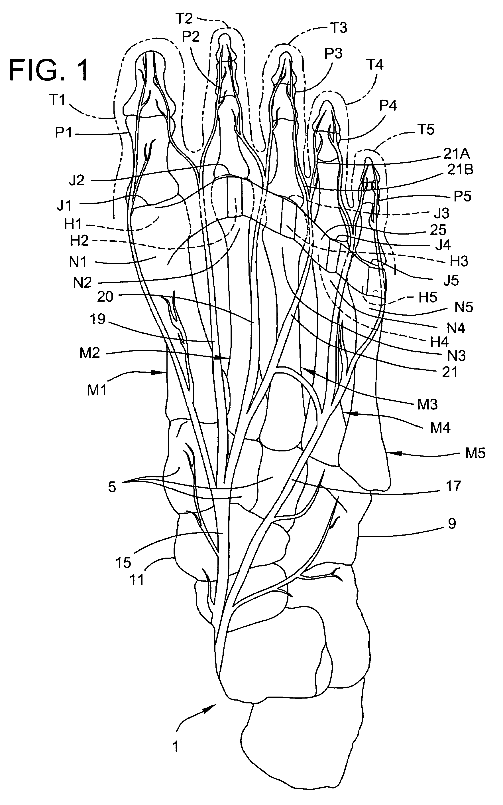 Insole with a neuroma pad