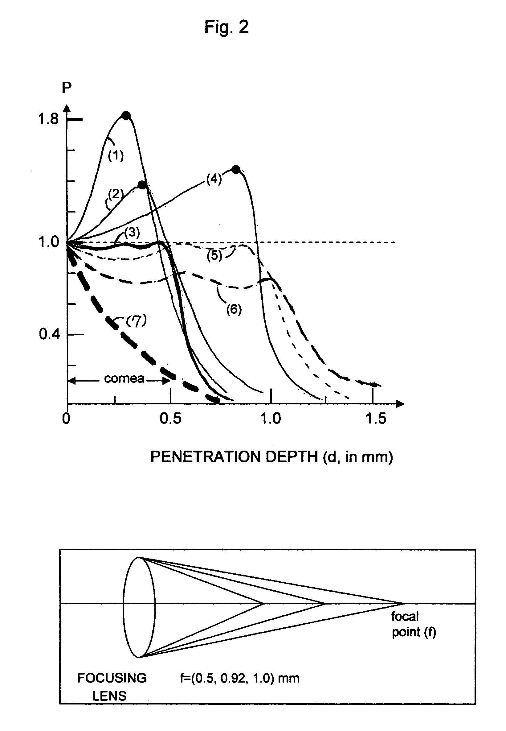 Method and system for non-invasive treatment of hyperopia, presbyopia and glaucoma