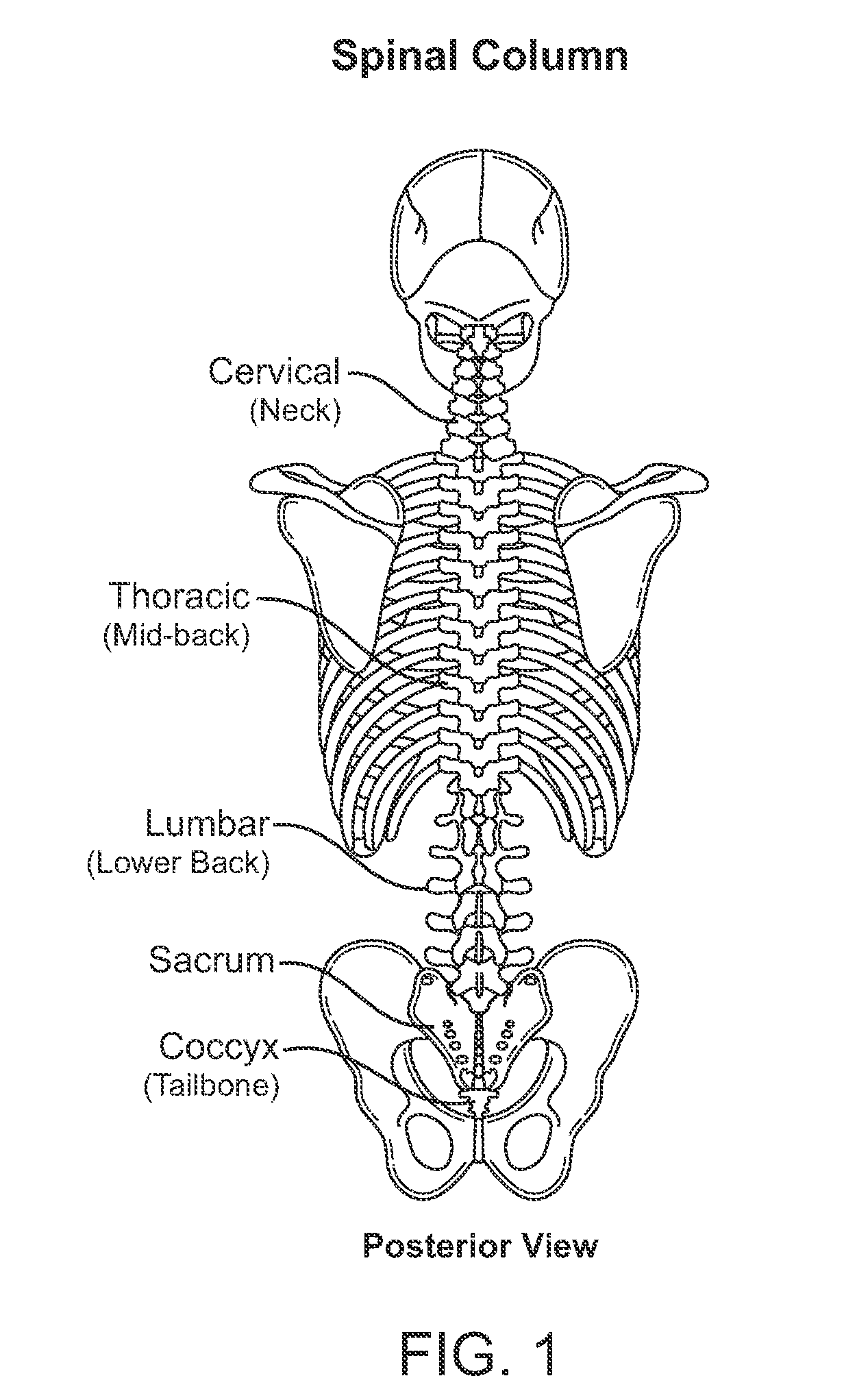 Systems and methods for implantable leadless spine stimulation