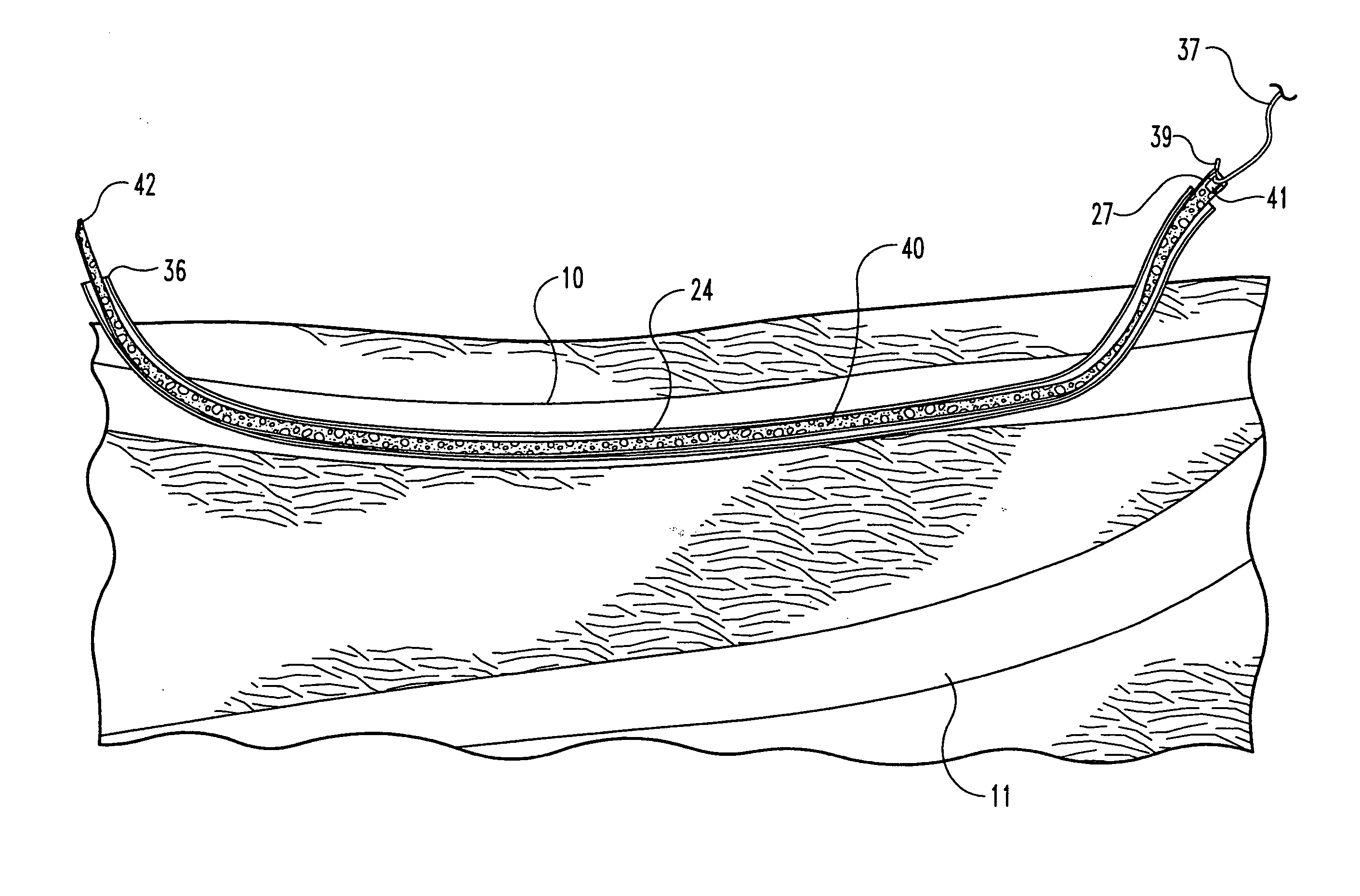 Vascular occlusion methods, systems and devices