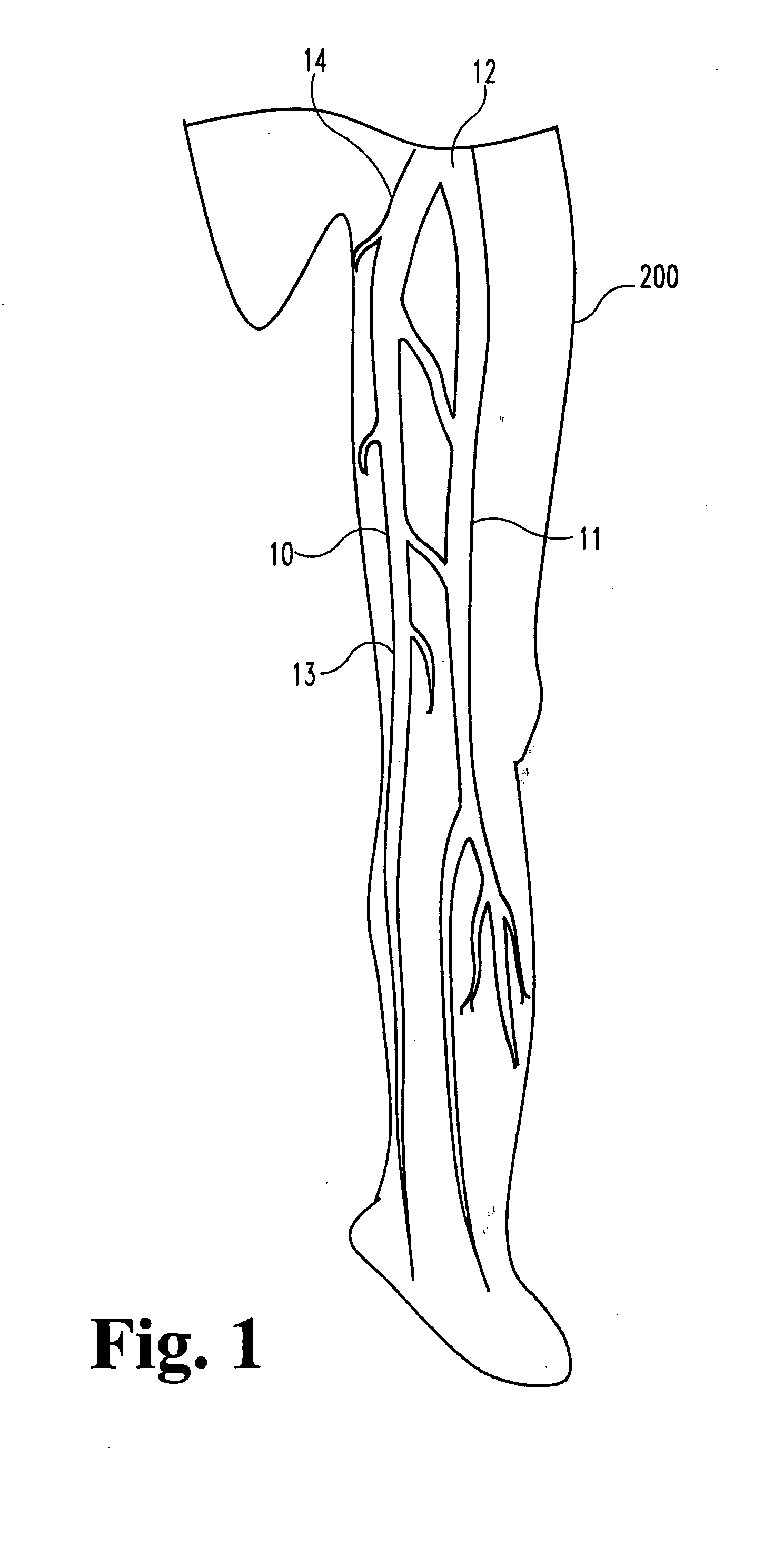 Vascular occlusion methods, systems and devices