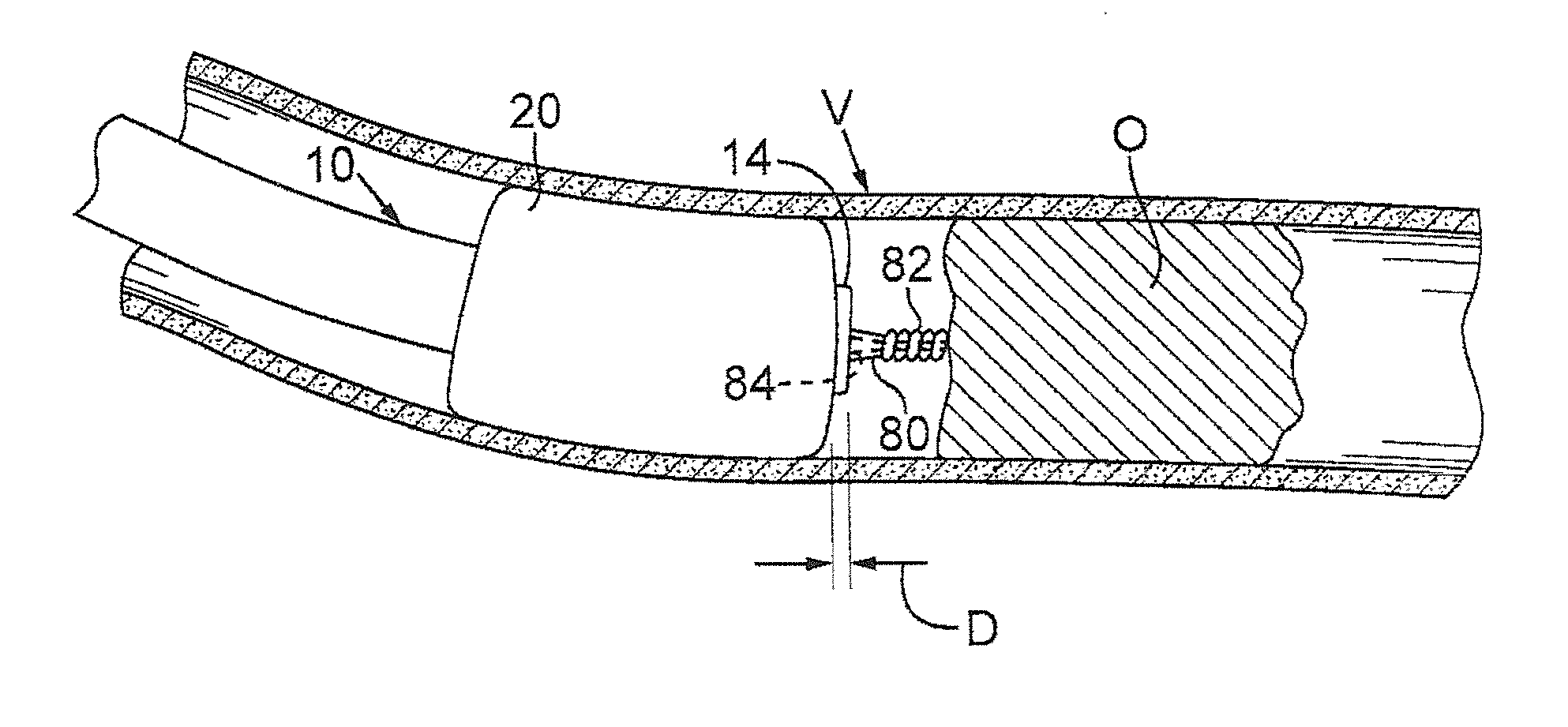 Devices and methods for treating chronic total occlusion