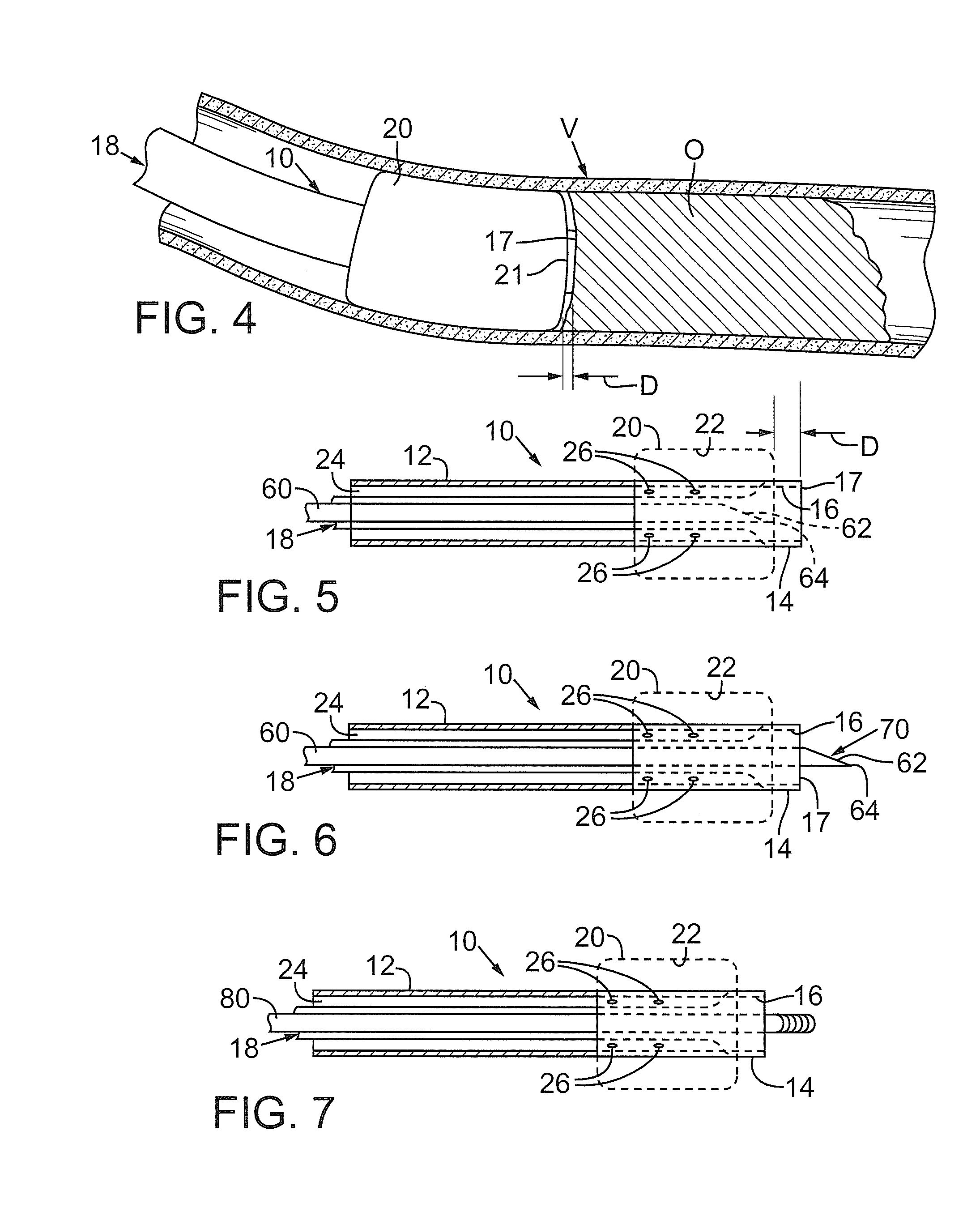 Devices and methods for treating chronic total occlusion