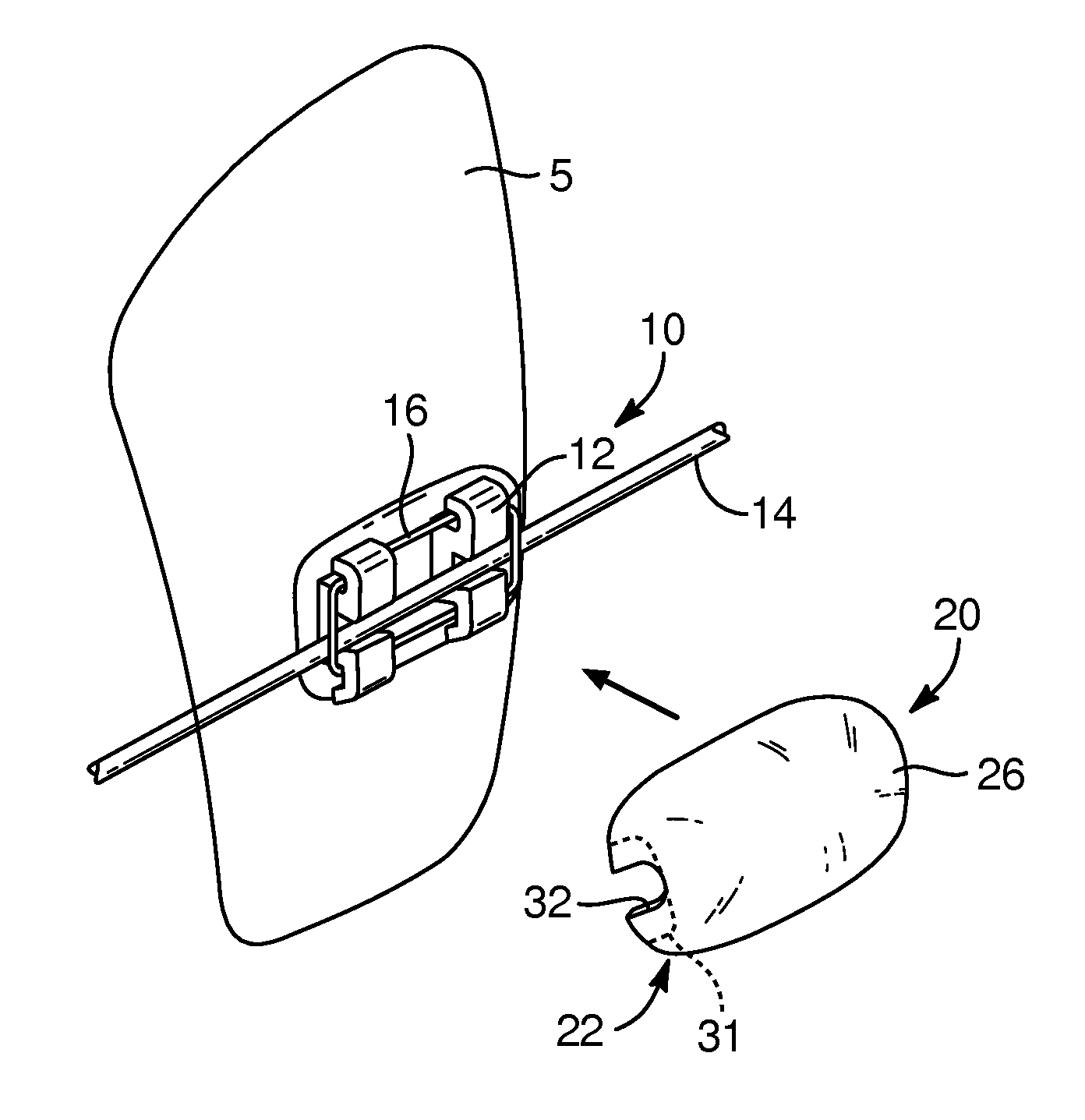 Devices, systems, and methods for orthodontic hardware