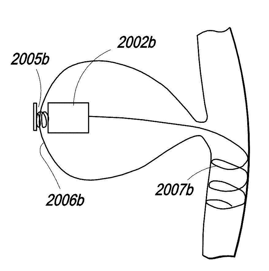 Device and implantation system for electrical stimulation of biological systems