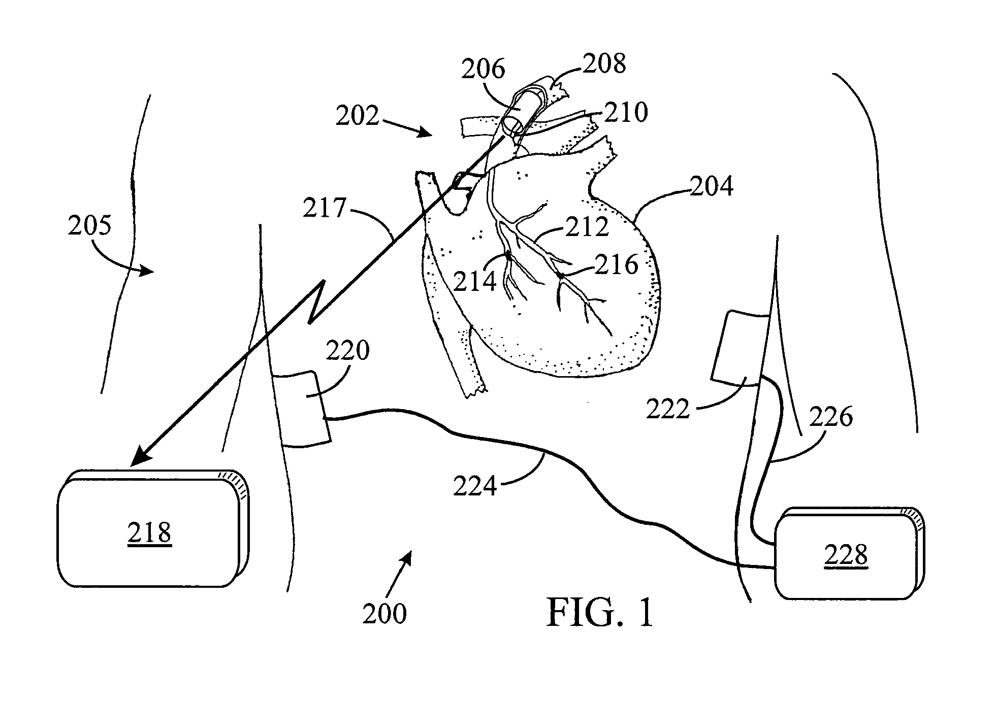 Signal sensing in an implanted apparatus with an internal reference