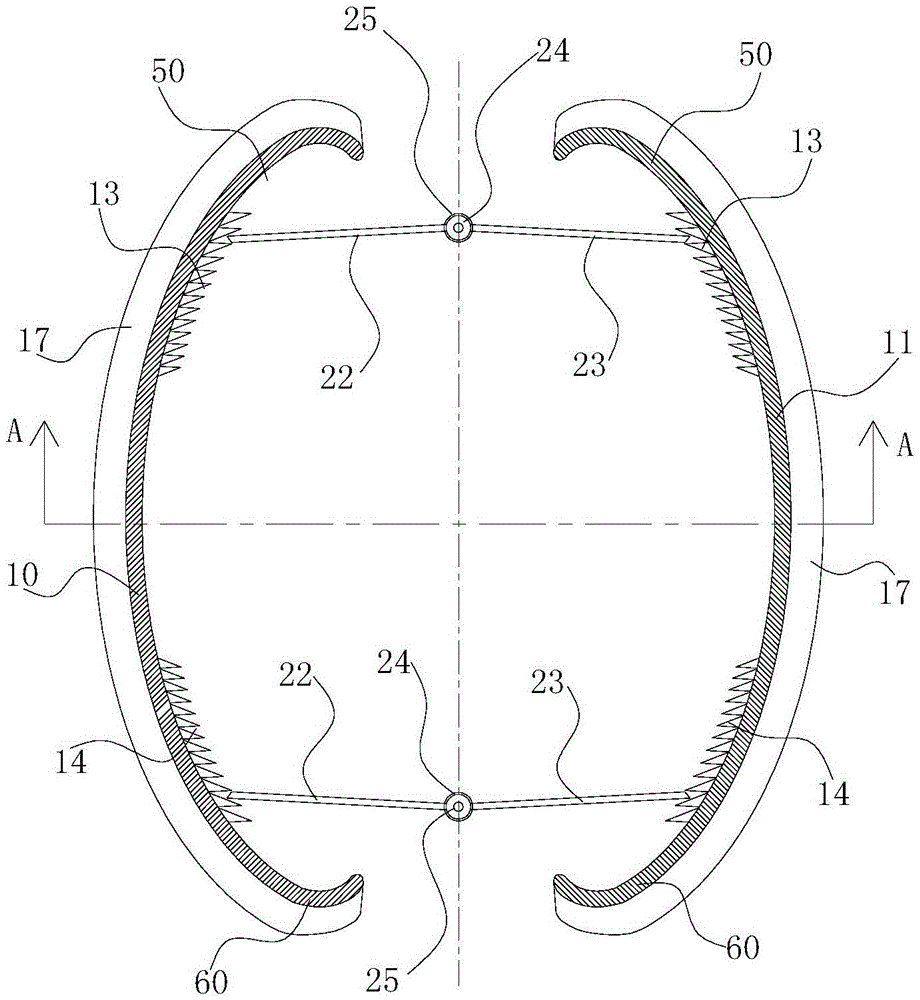 Surgical plate-type distracter