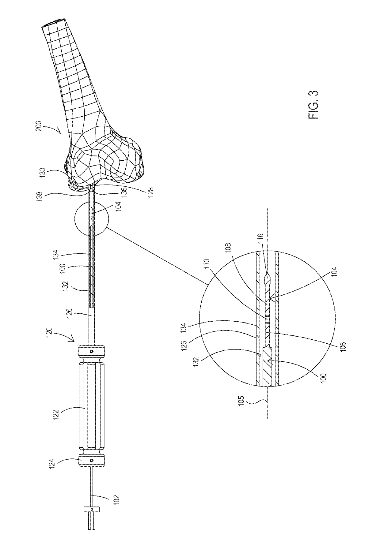 Bone material removal device and a method for use thereof