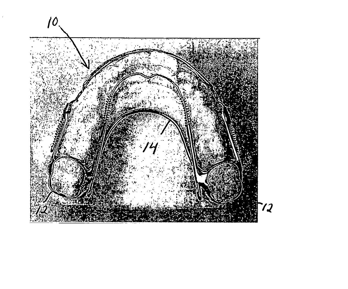 Orthodontic appliance and method