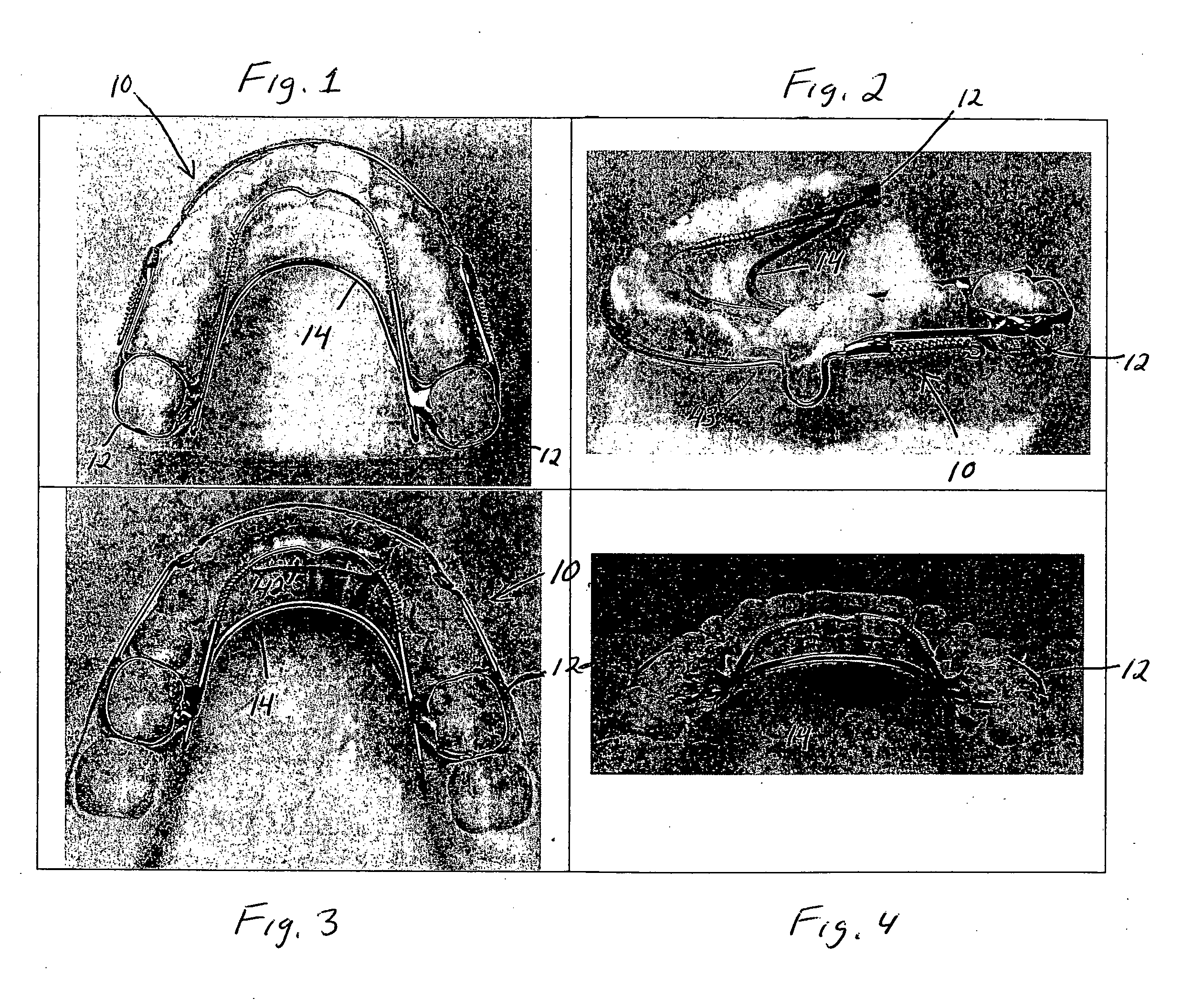 Orthodontic appliance and method