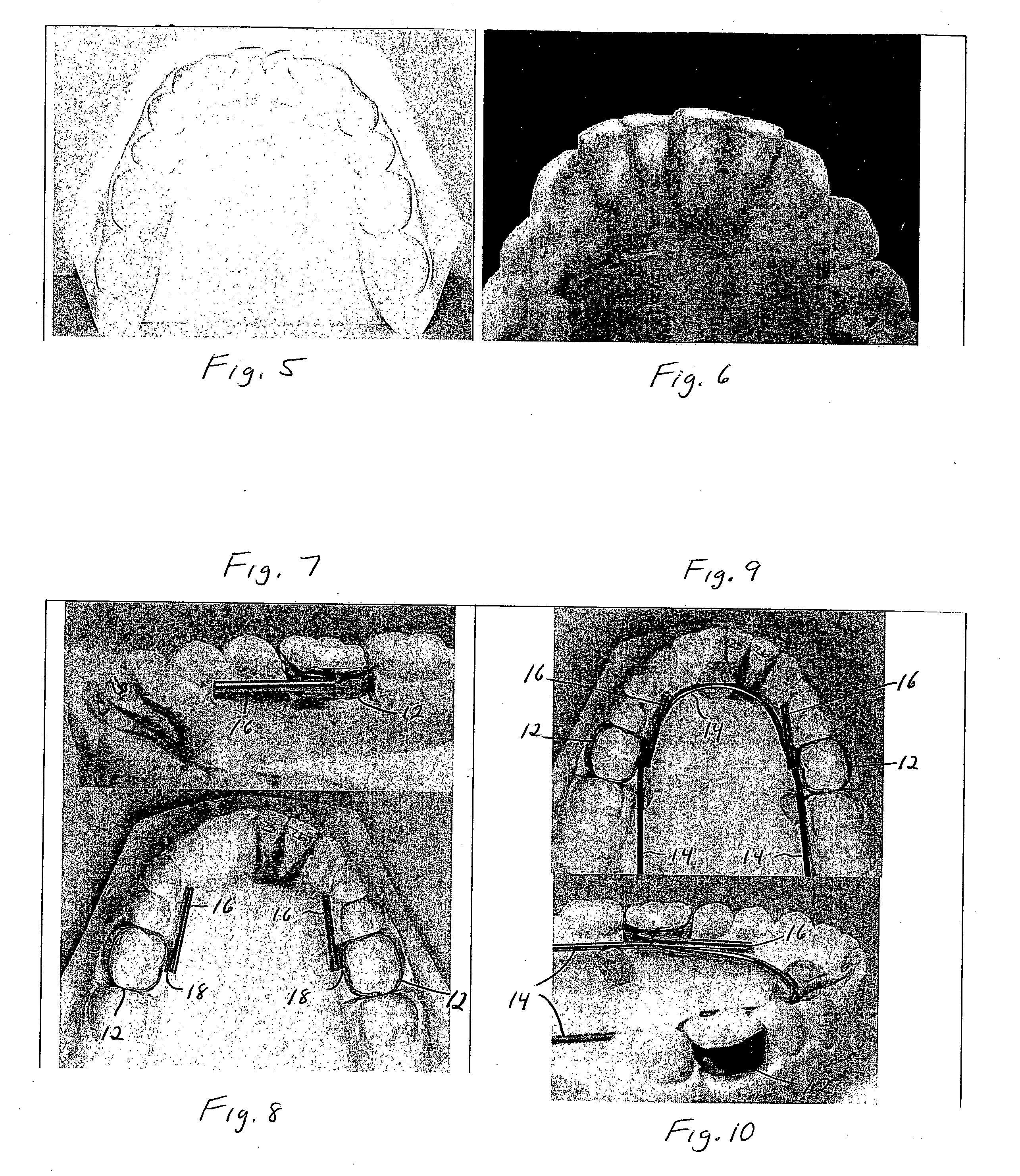 Orthodontic appliance and method