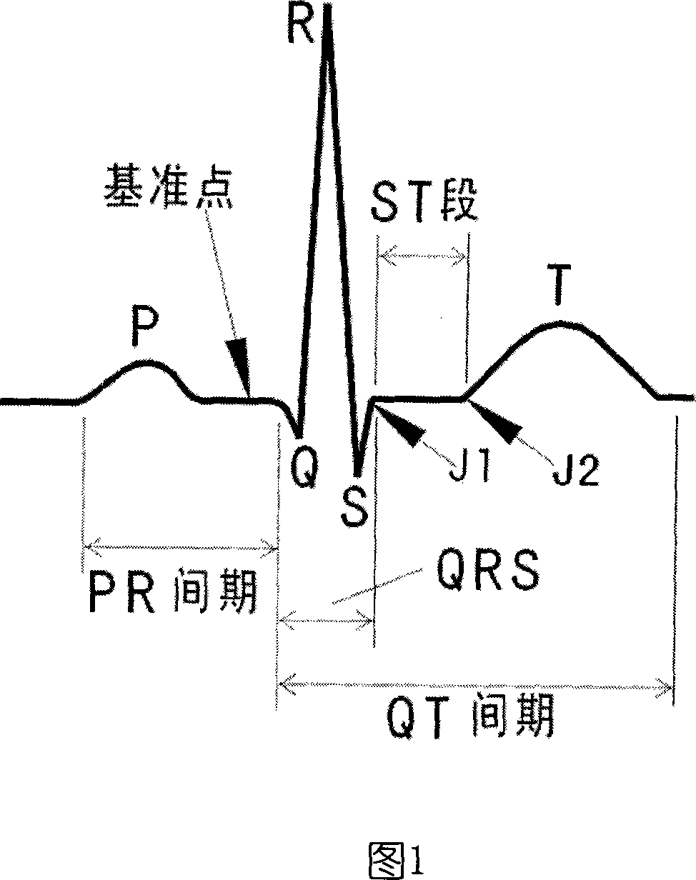 Automatic recognition of EC G ST section based on template match