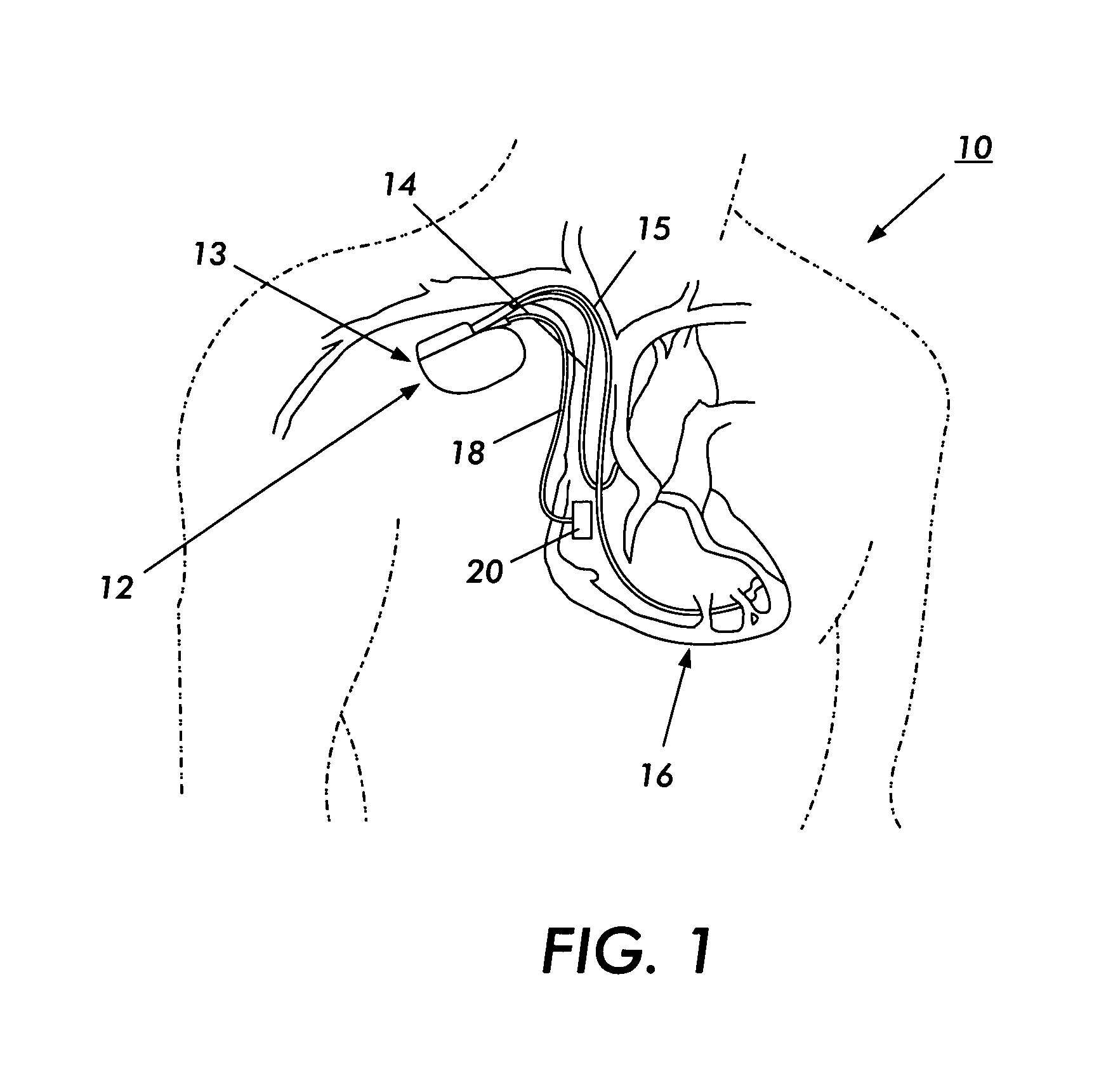 Fibrillation/tachycardia monitoring and preventive system and methodology