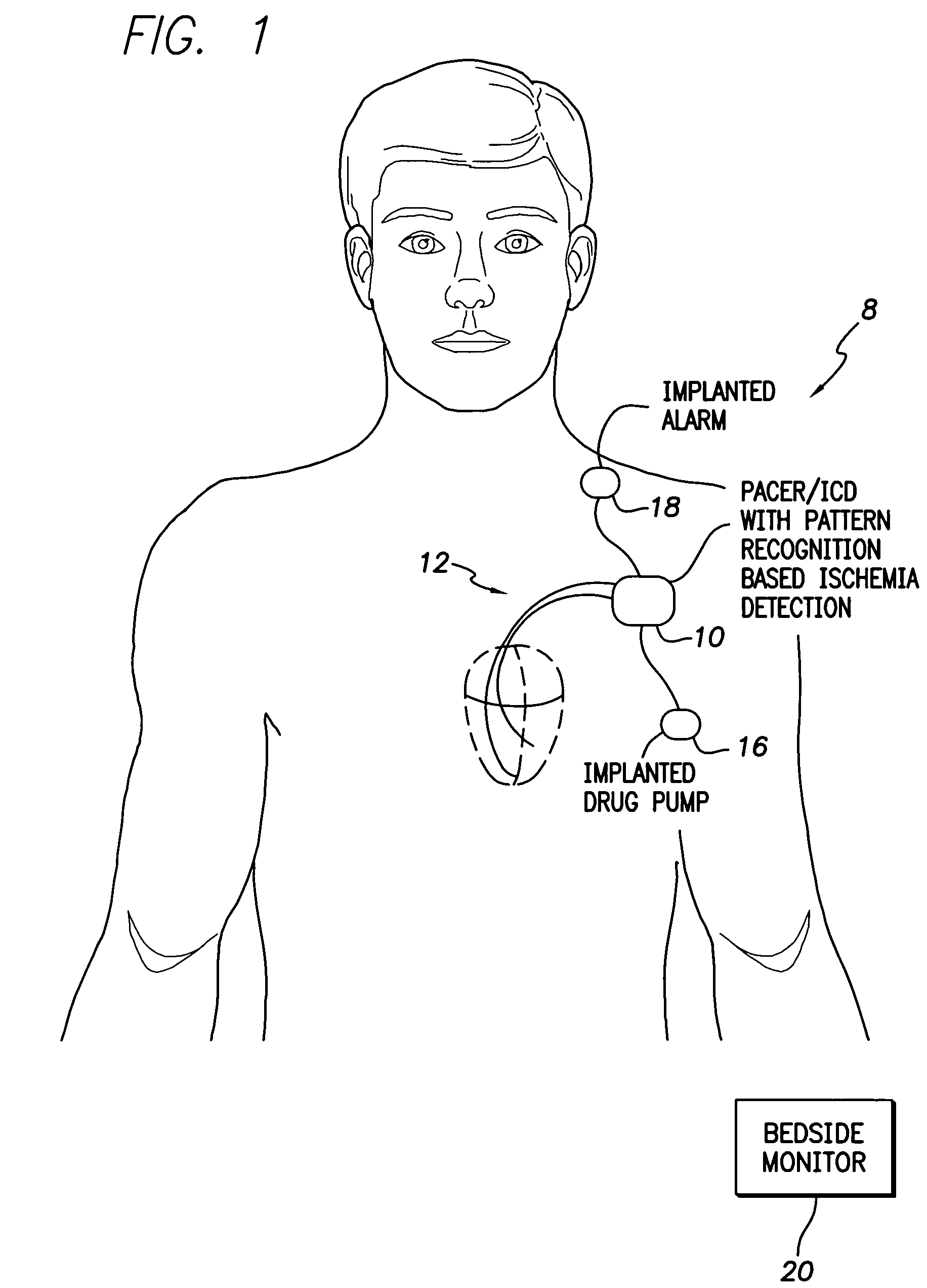 System and method for detecting cardiac ischemia in real-time using a pattern classifier implemented within an implanted medical device