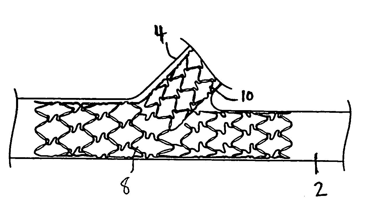 Stent with protruding branch portion for bifurcated vessels