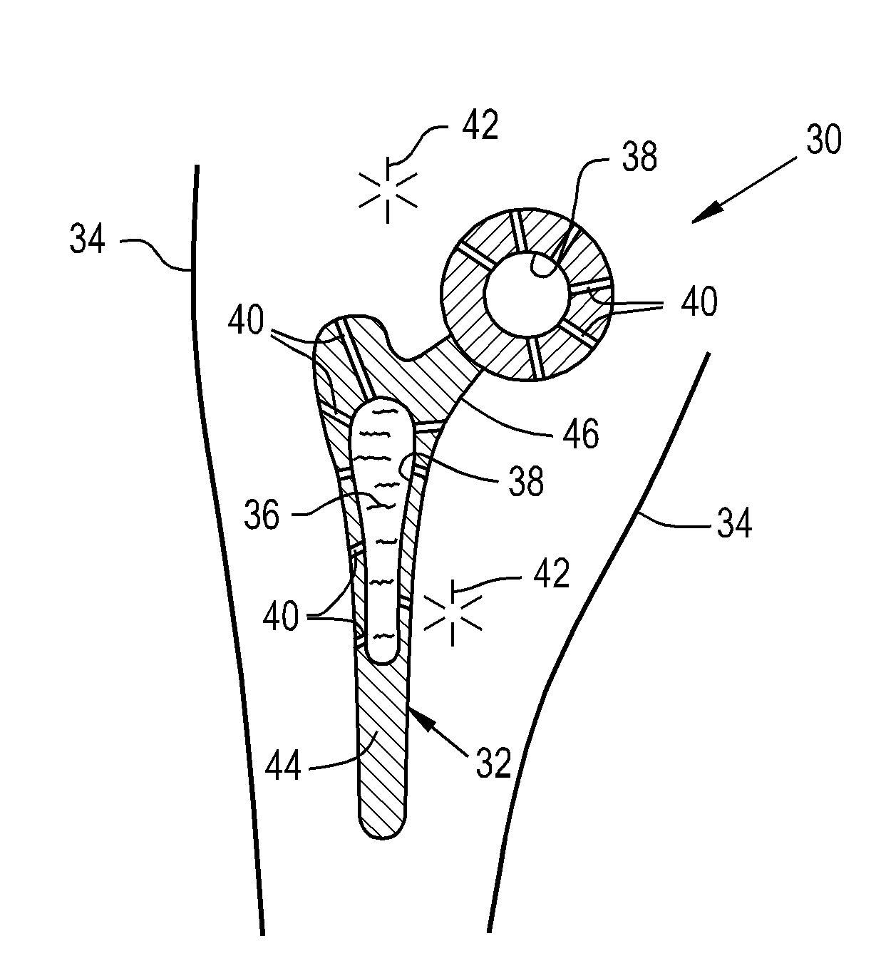 Drug delivery implants