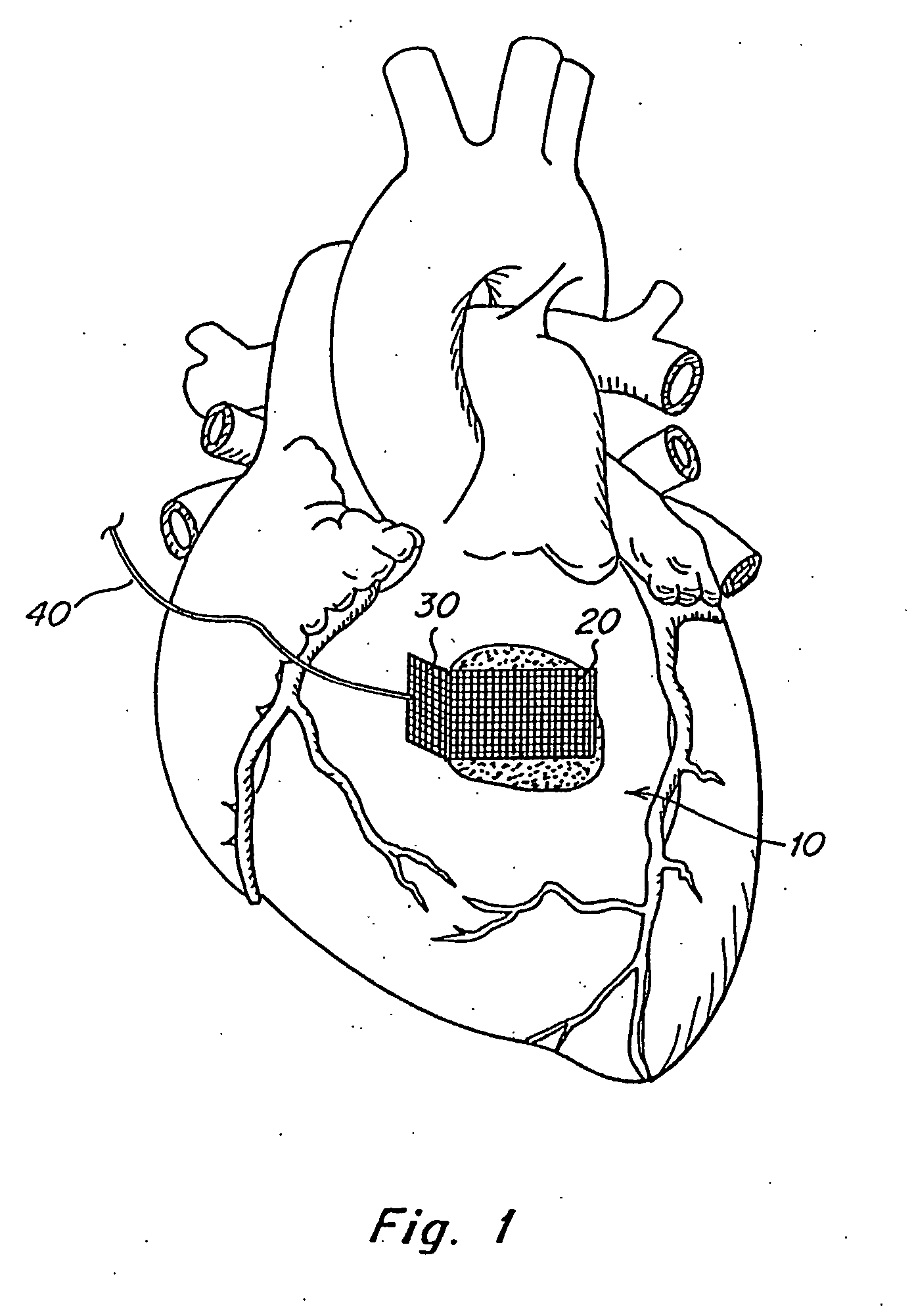 Biodegradable tissue retractor