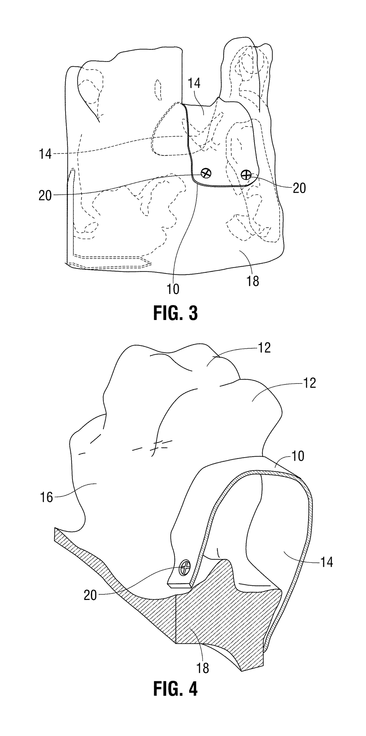 Method and system for making and using an occlusive barrier for bone regeneration and occlusive barrier obtained by said method